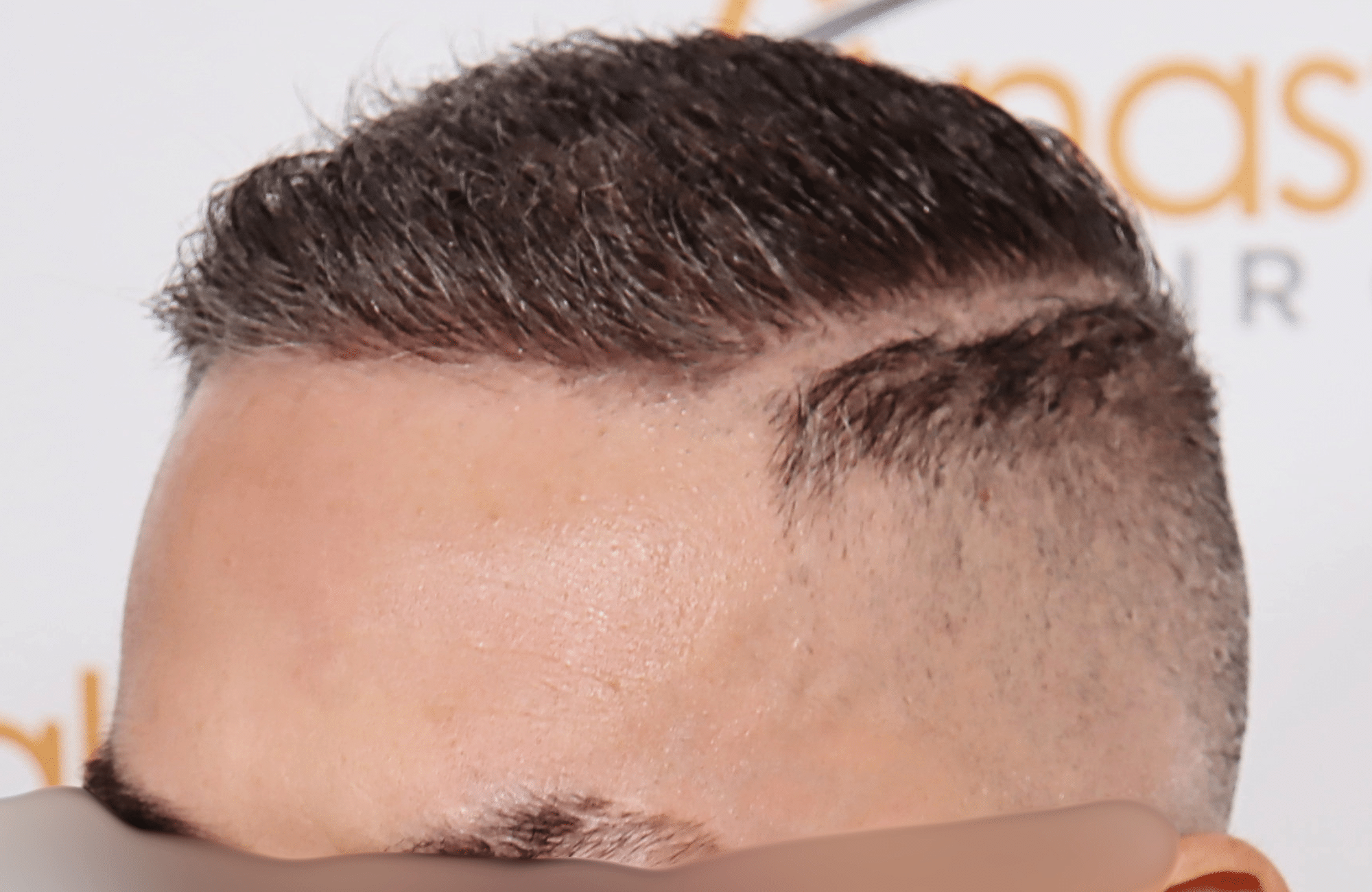 hair transplant result 2600 fus