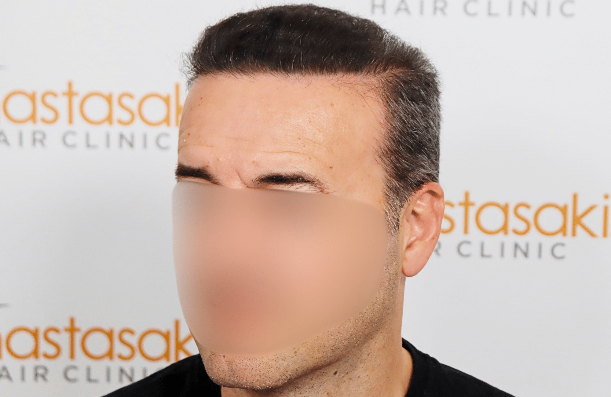 hair transplant result 2600 fus