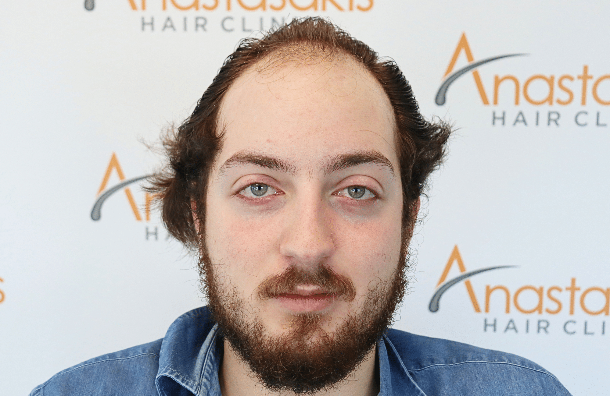 hair transplant result 2600 fus (8)