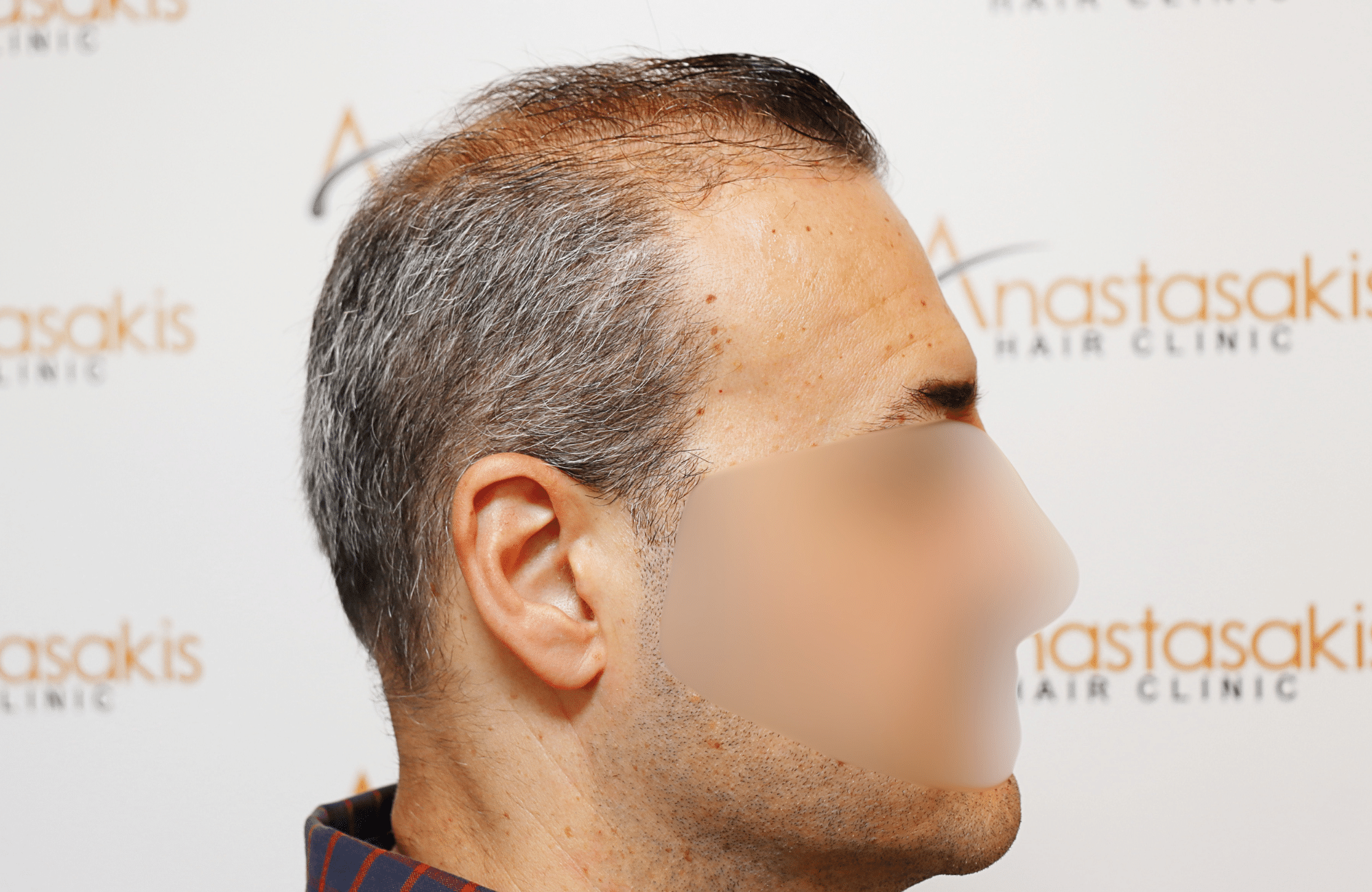 hair transplant result 2600 fus