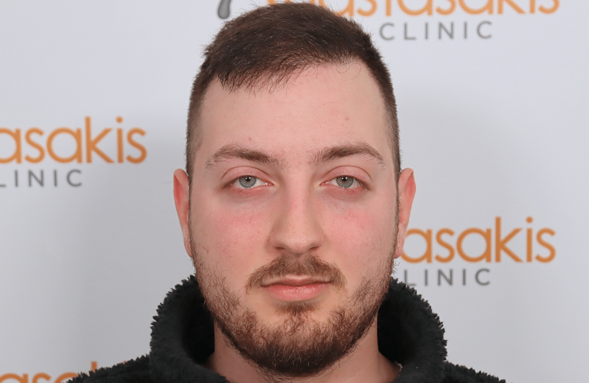 hair transplant result 2600 fus (9)