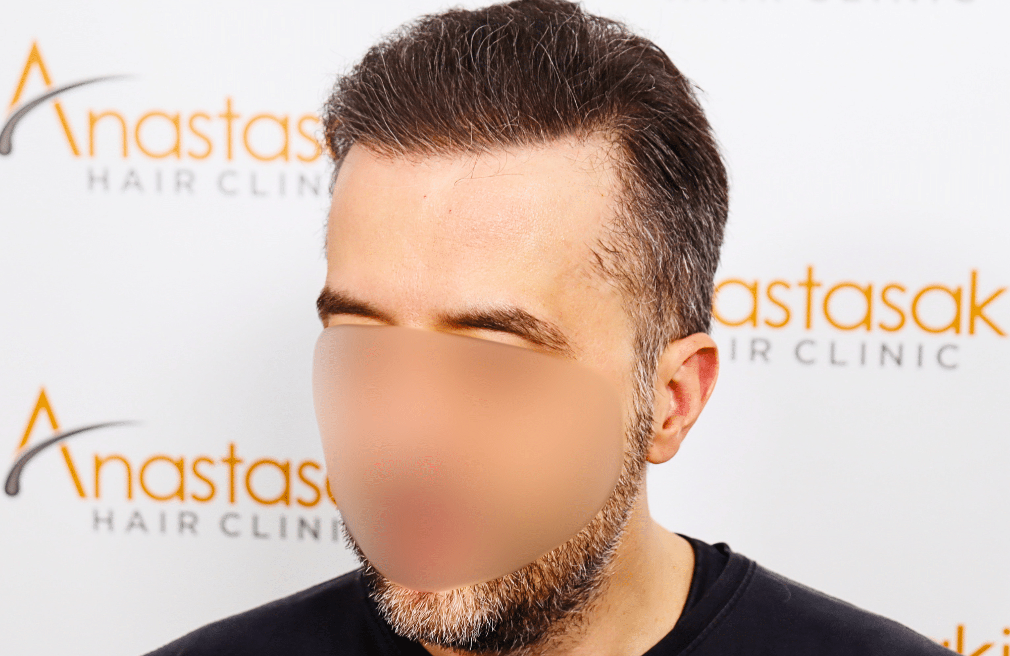 hair transplant result 2600 fus difusse thinning Grey