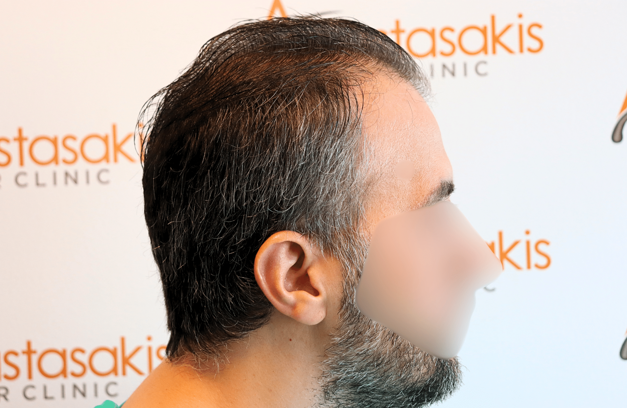 hair transplant result 2600 fus difusse thinning Grey