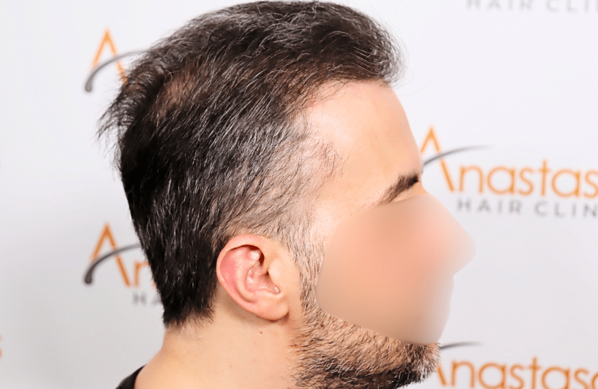 hair transplant result 2600 fus difusse thinning Grey