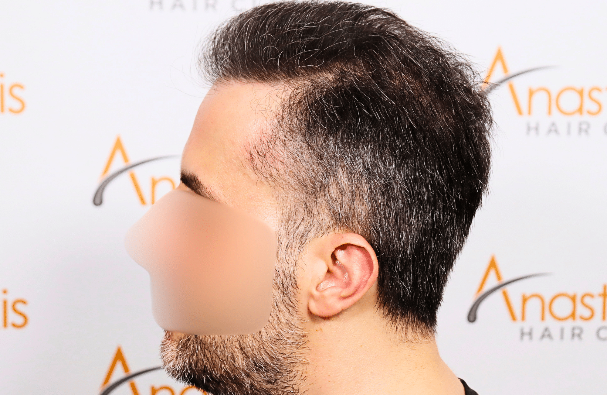 hair transplant result 2600 fus difusse thinning Grey