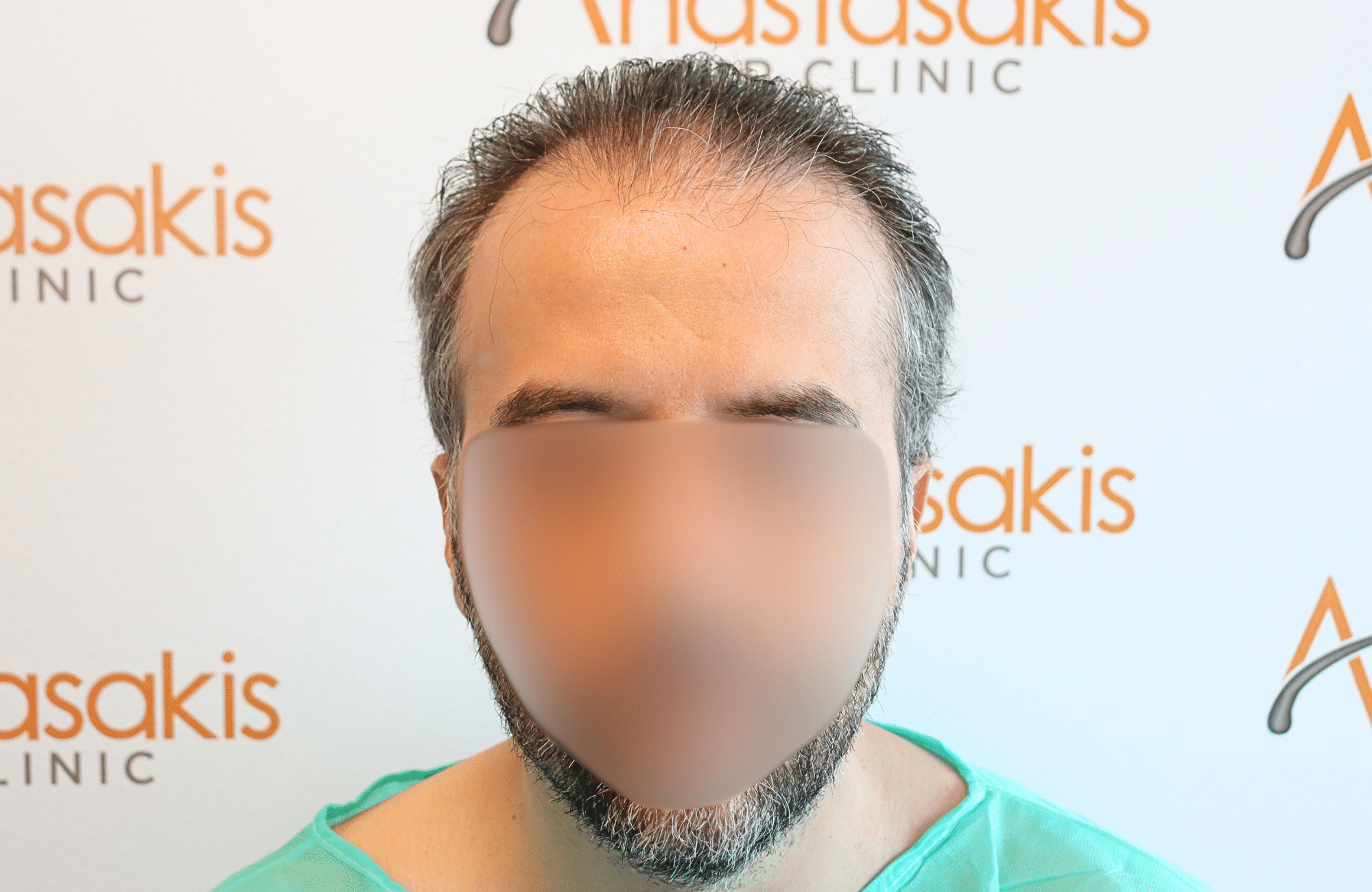 hair transplant result 2600 fus difusse thinning Grey