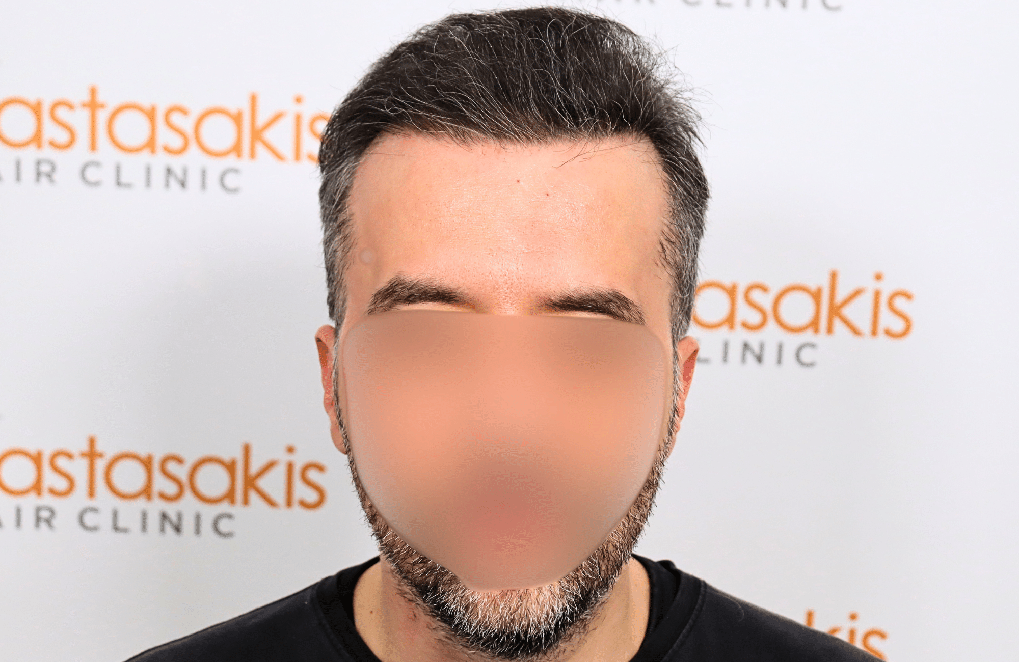 hair transplant result 2600 fus difusse thinning Grey