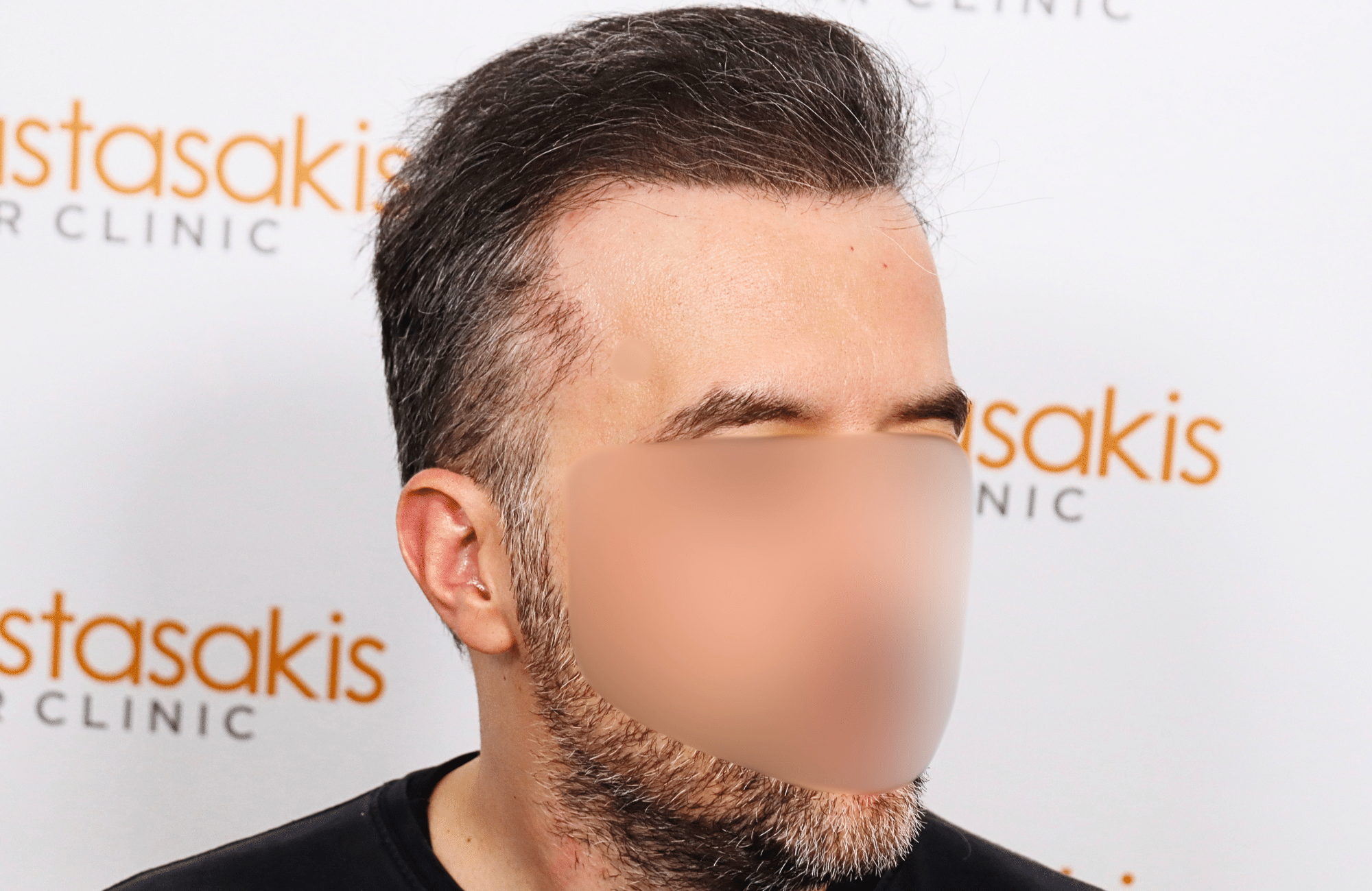 hair transplant result 2600 fus difusse thinning Grey