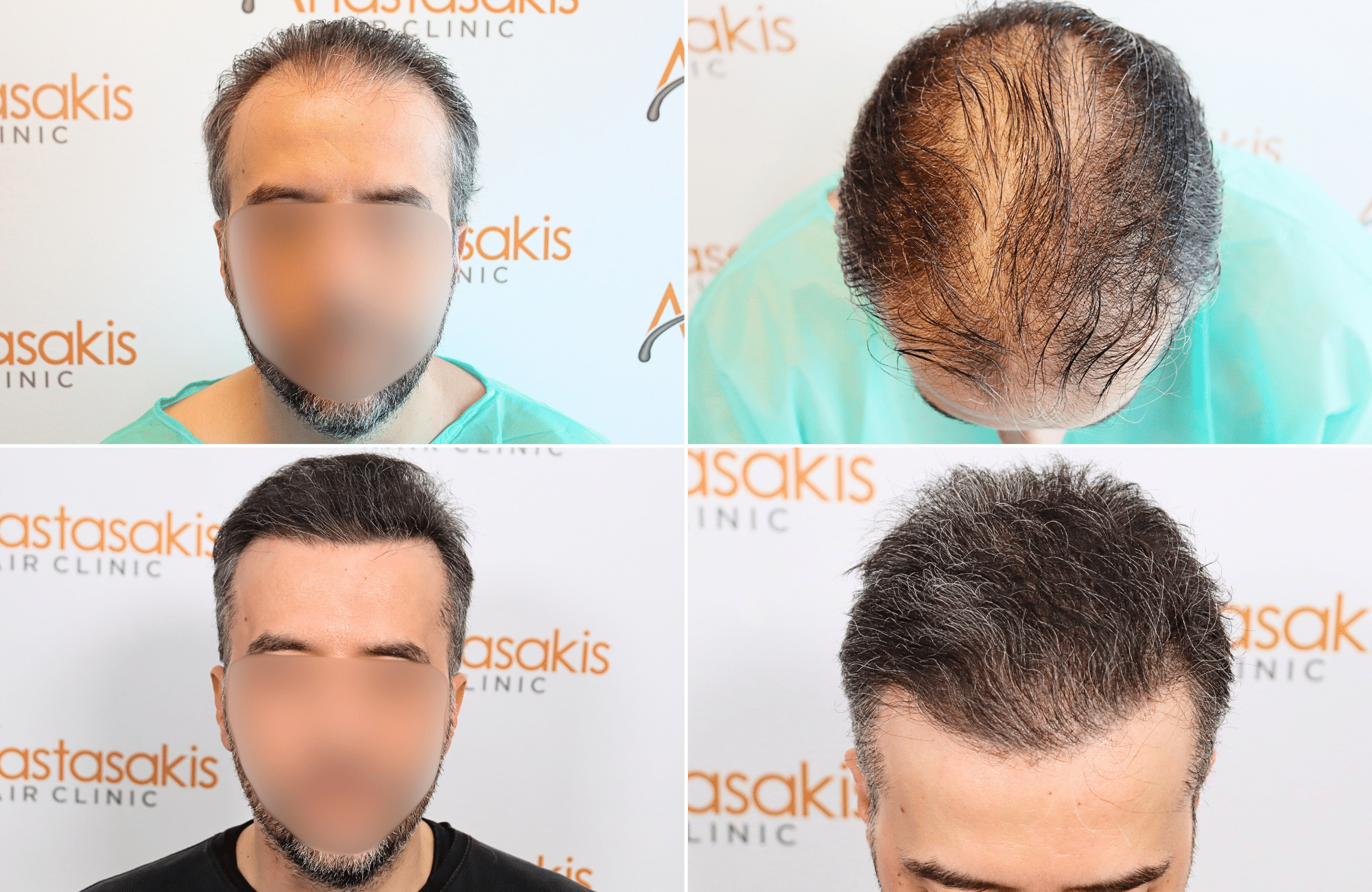https://www.anastasakishairclinic.gr/portfolio/apotelesma-metamosxefsis-mallion-anastasakis-hair-clinic-236/