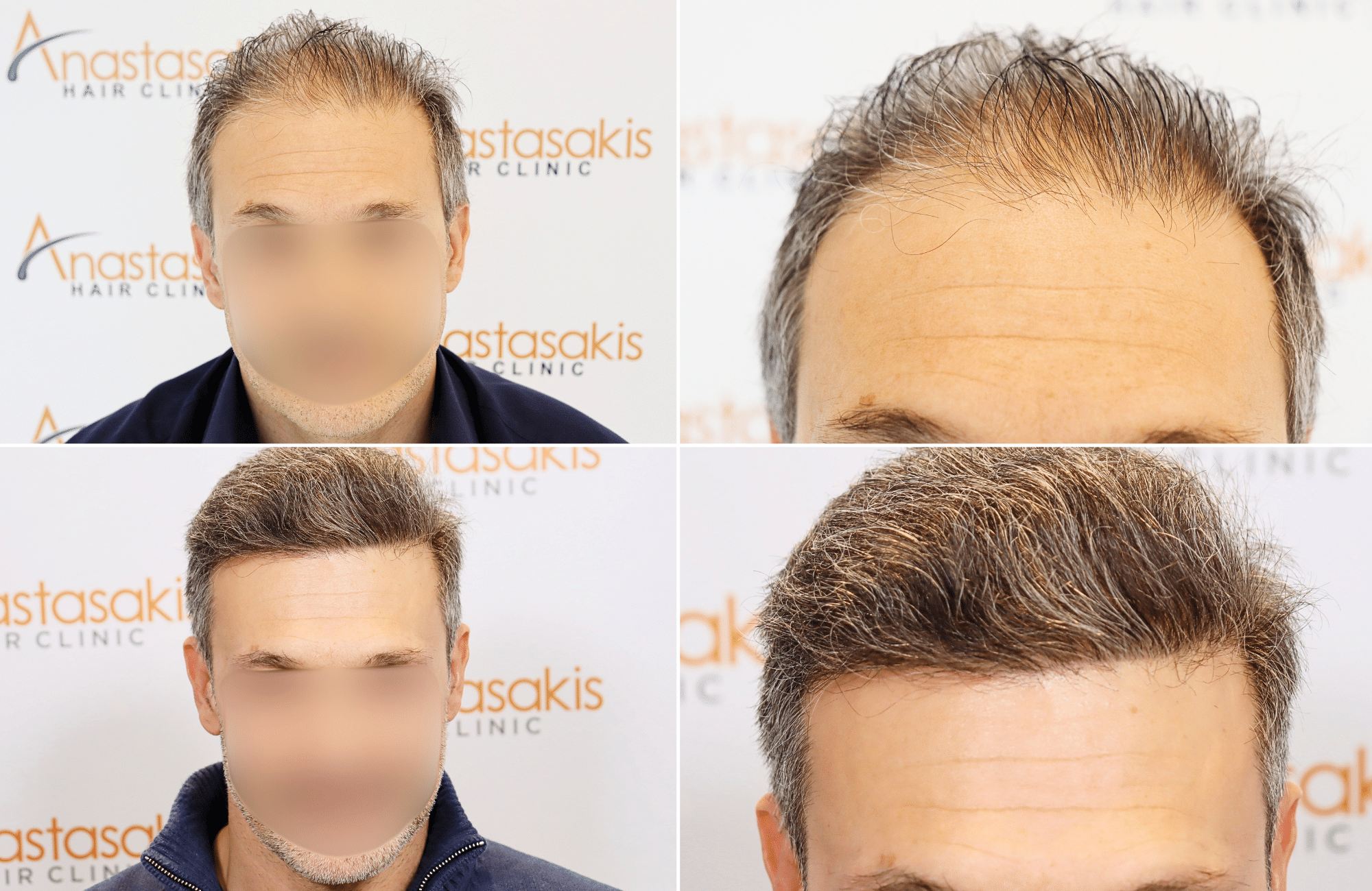 https://www.anastasakishairclinic.gr/portfolio/apotelesma-metamosxefsis-mallion-anastasakis-hair-clinic-42/