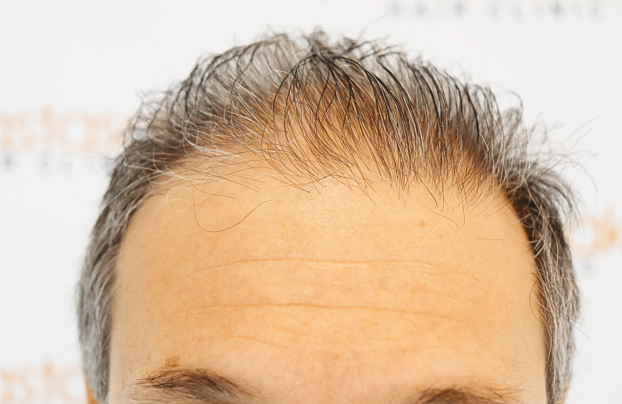 hair transplant result 2600 fus first stage grey (13)