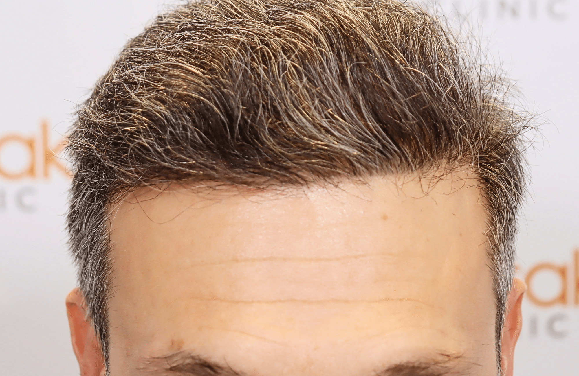 hair transplant result 2600 fus first stage grey (14)