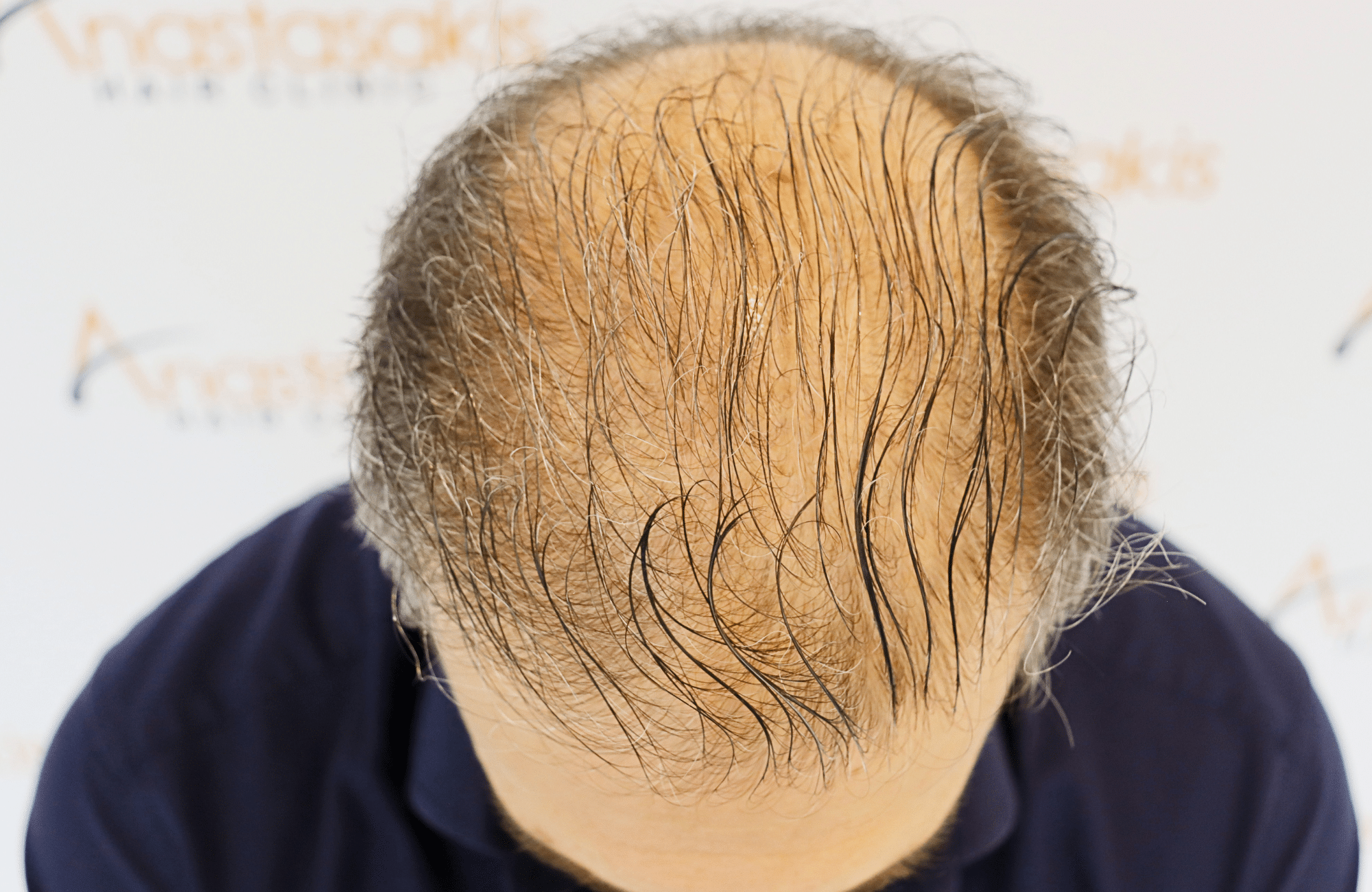 hair transplant result 2600 fus first stage grey (15)