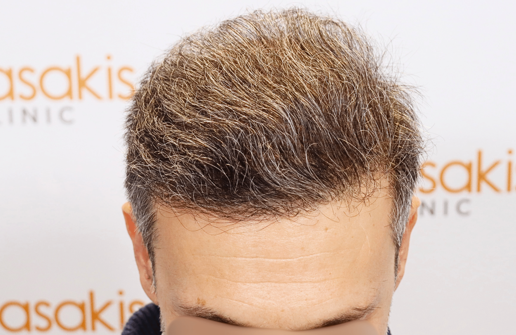 hair transplant result 2600 fus first stage grey (16)