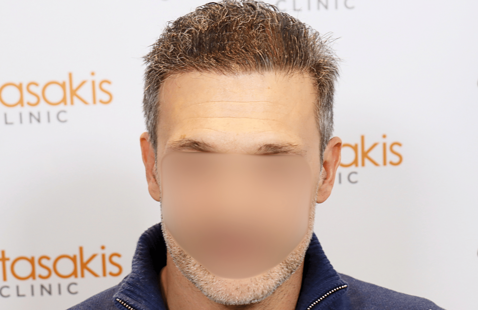 hair transplant result 2600 fus first stage grey