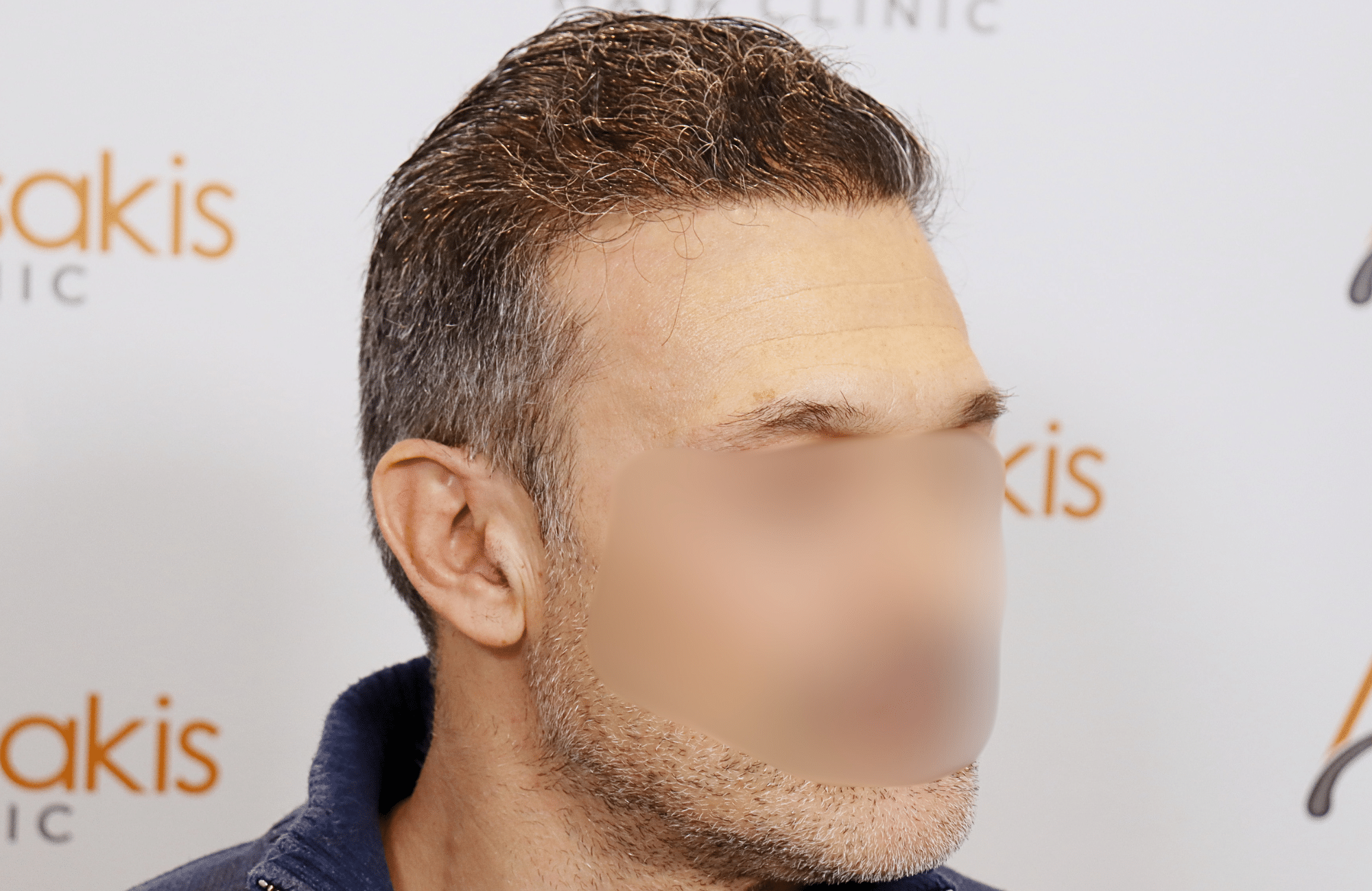 hair transplant result 2600 fus first stage grey