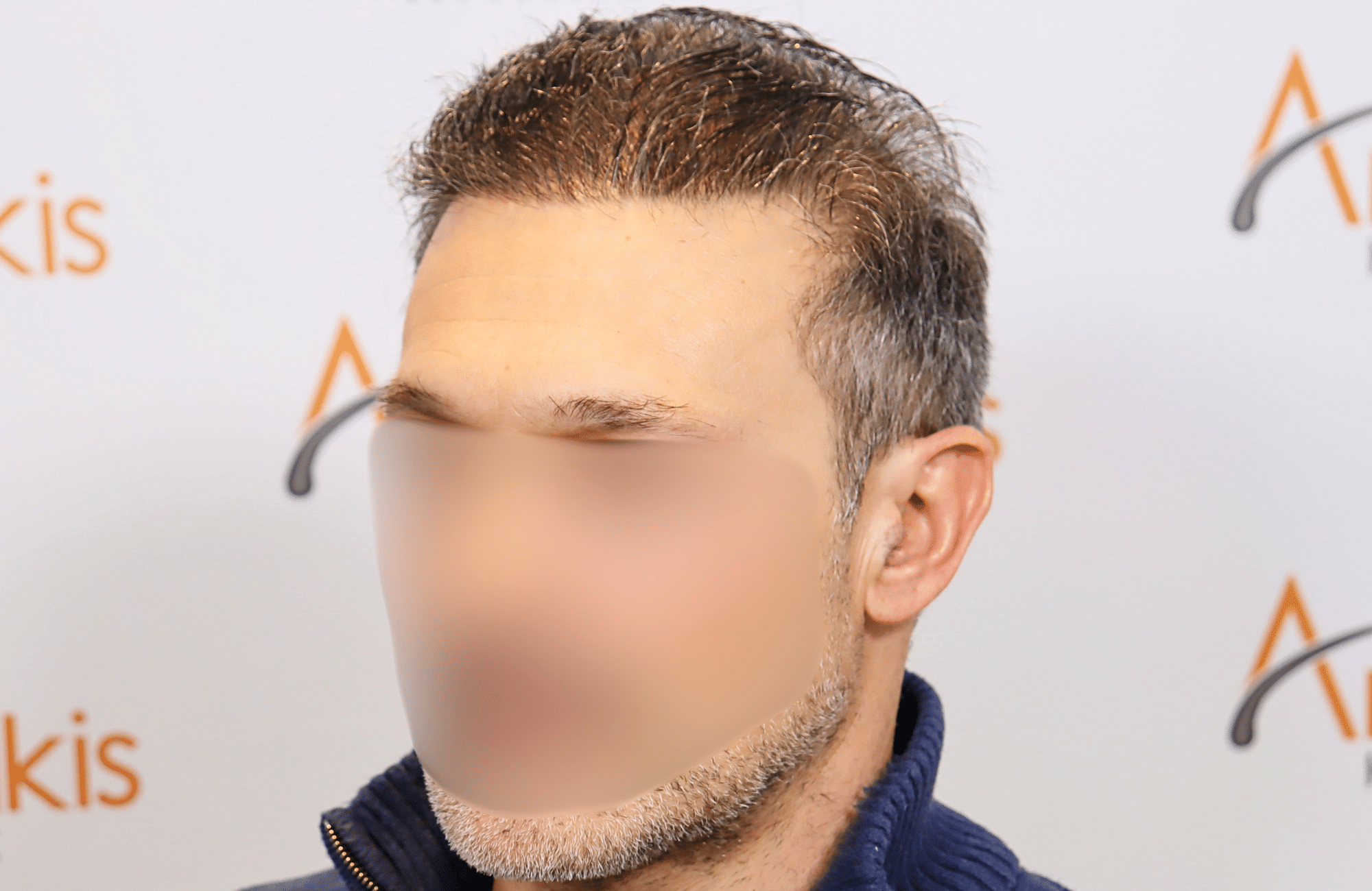 hair transplant result 2600 fus first stage grey