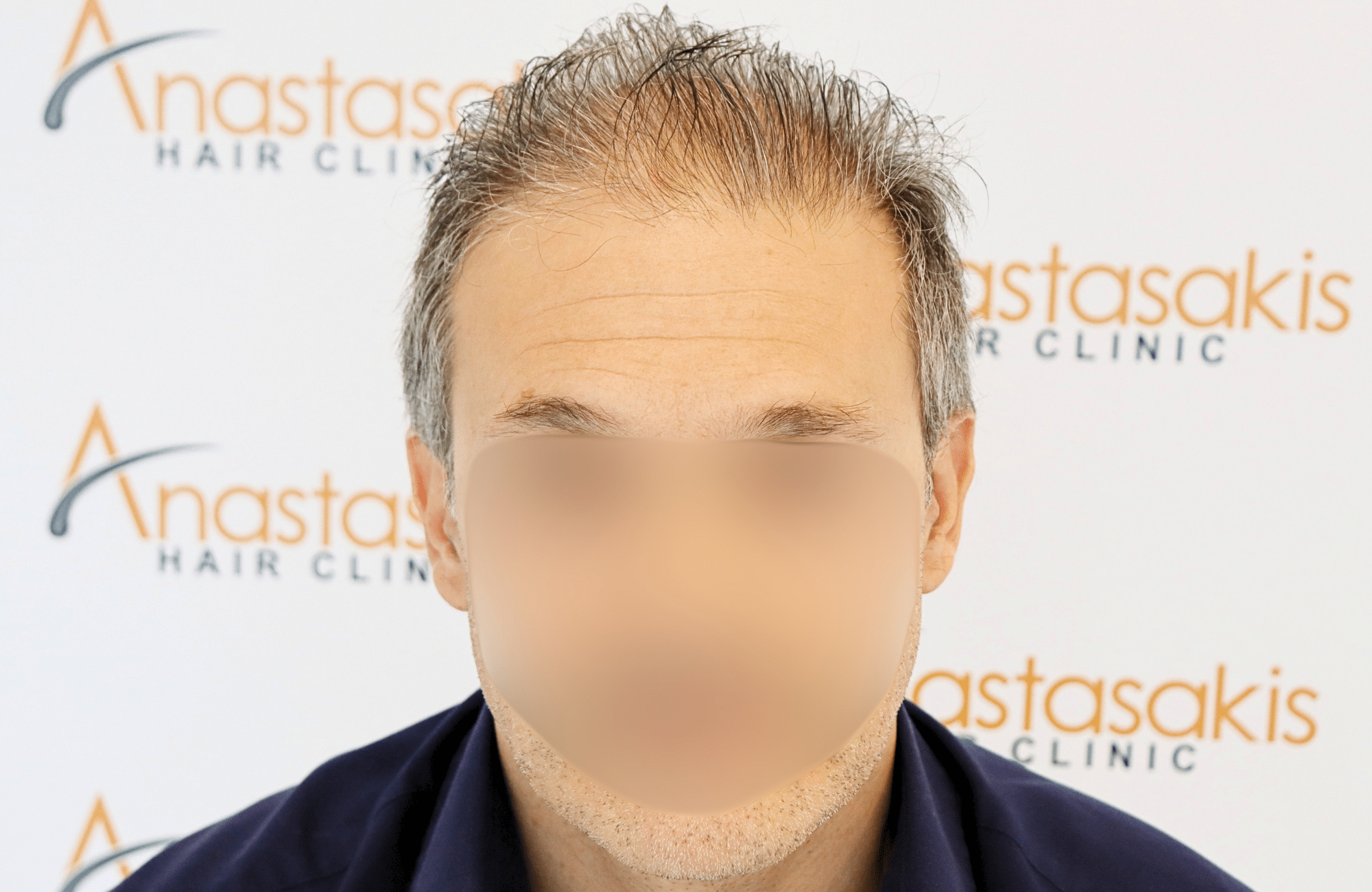 hair transplant result 2600 fus first stage grey (1)