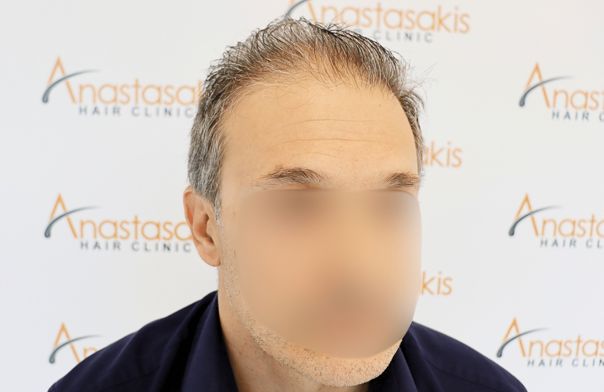 hair transplant result 2600 fus first stage grey
