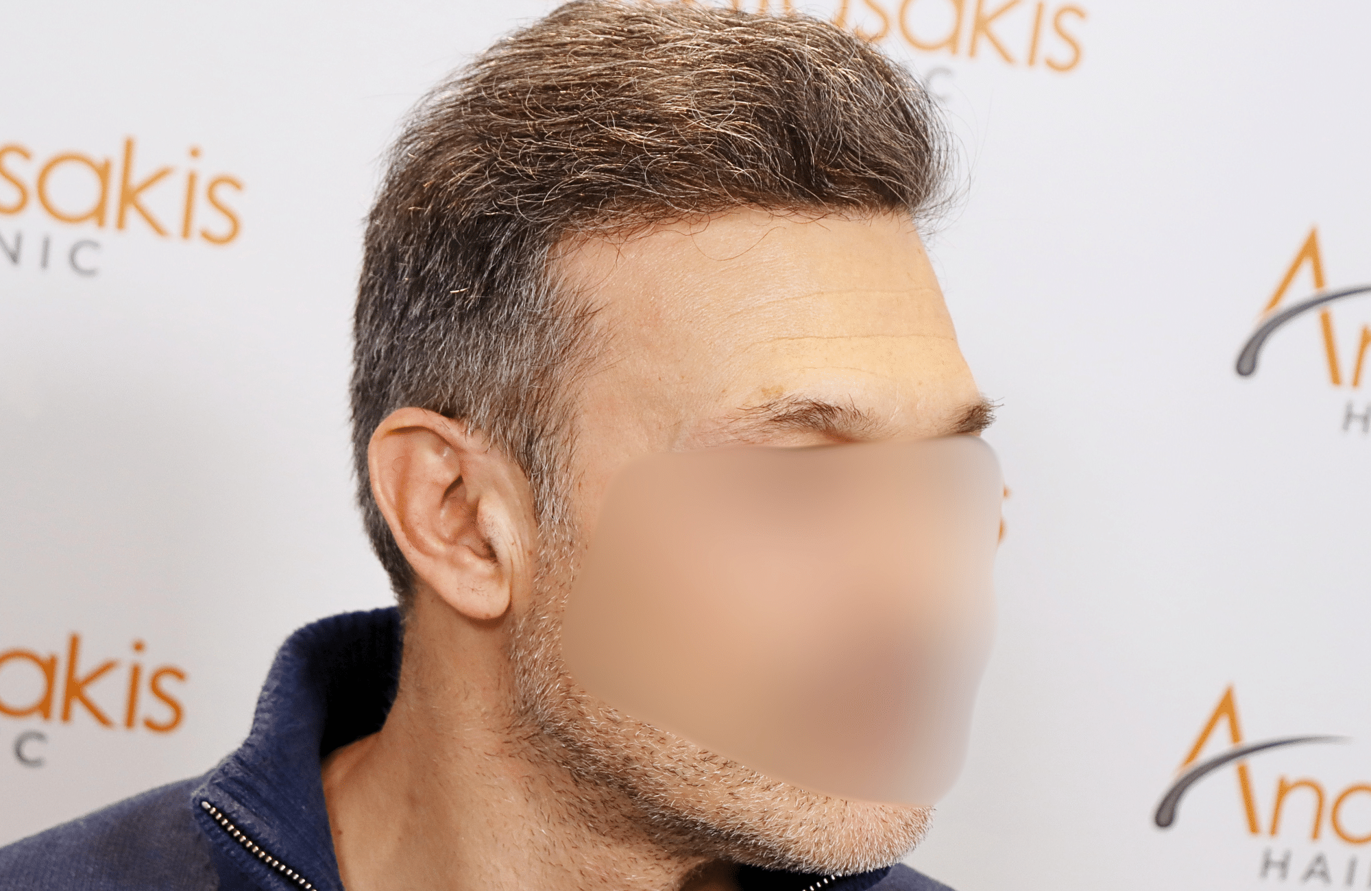 hair transplant result 2600 fus first stage grey