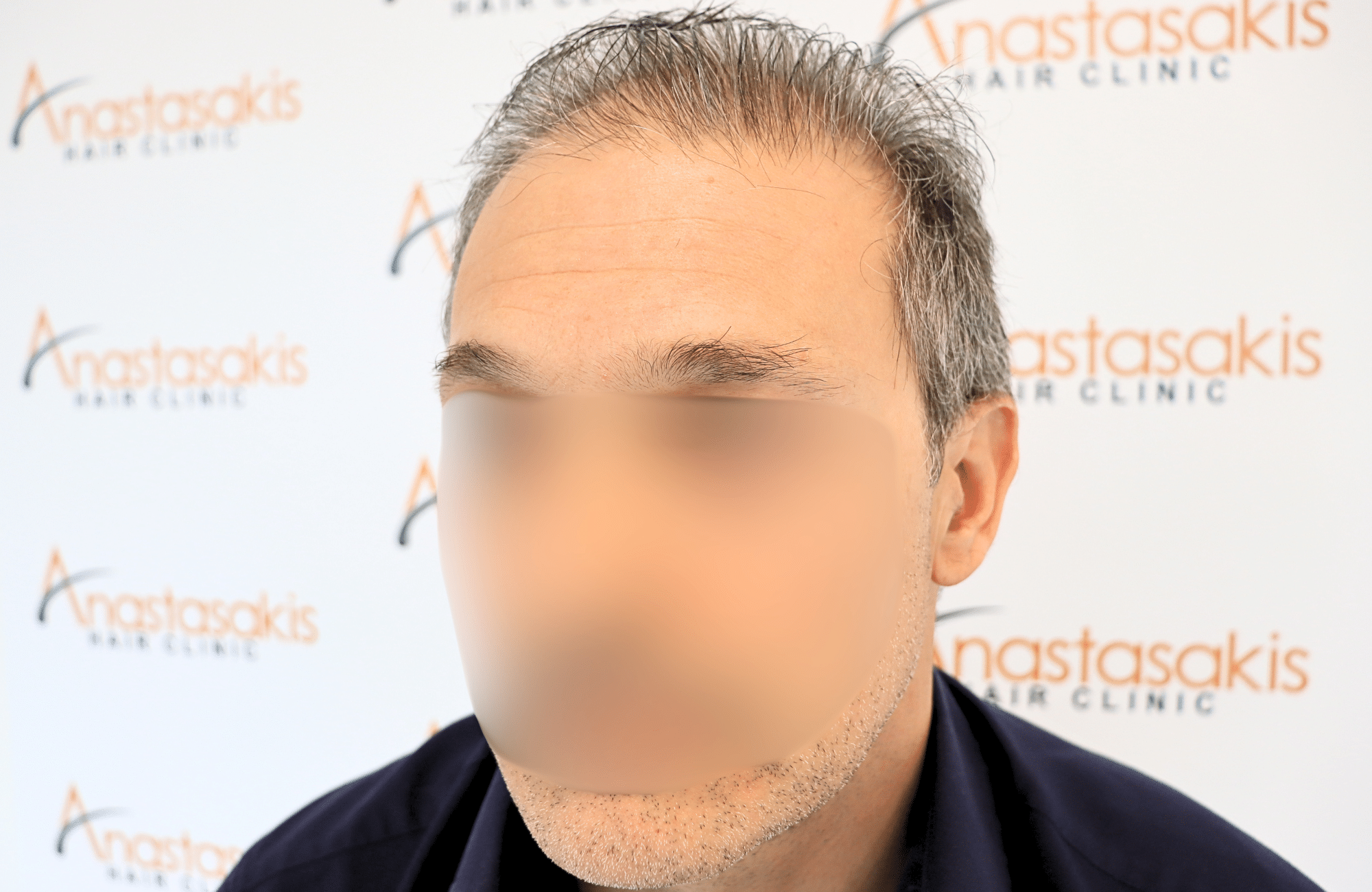 hair transplant result 2600 fus first stage grey (7)