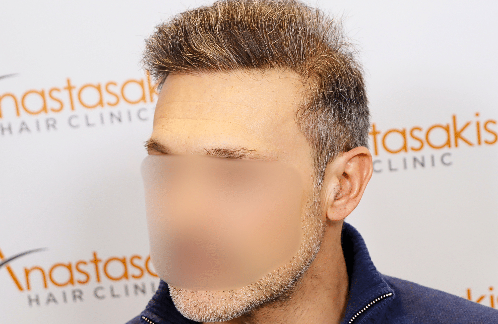hair transplant result 2600 fus first stage grey