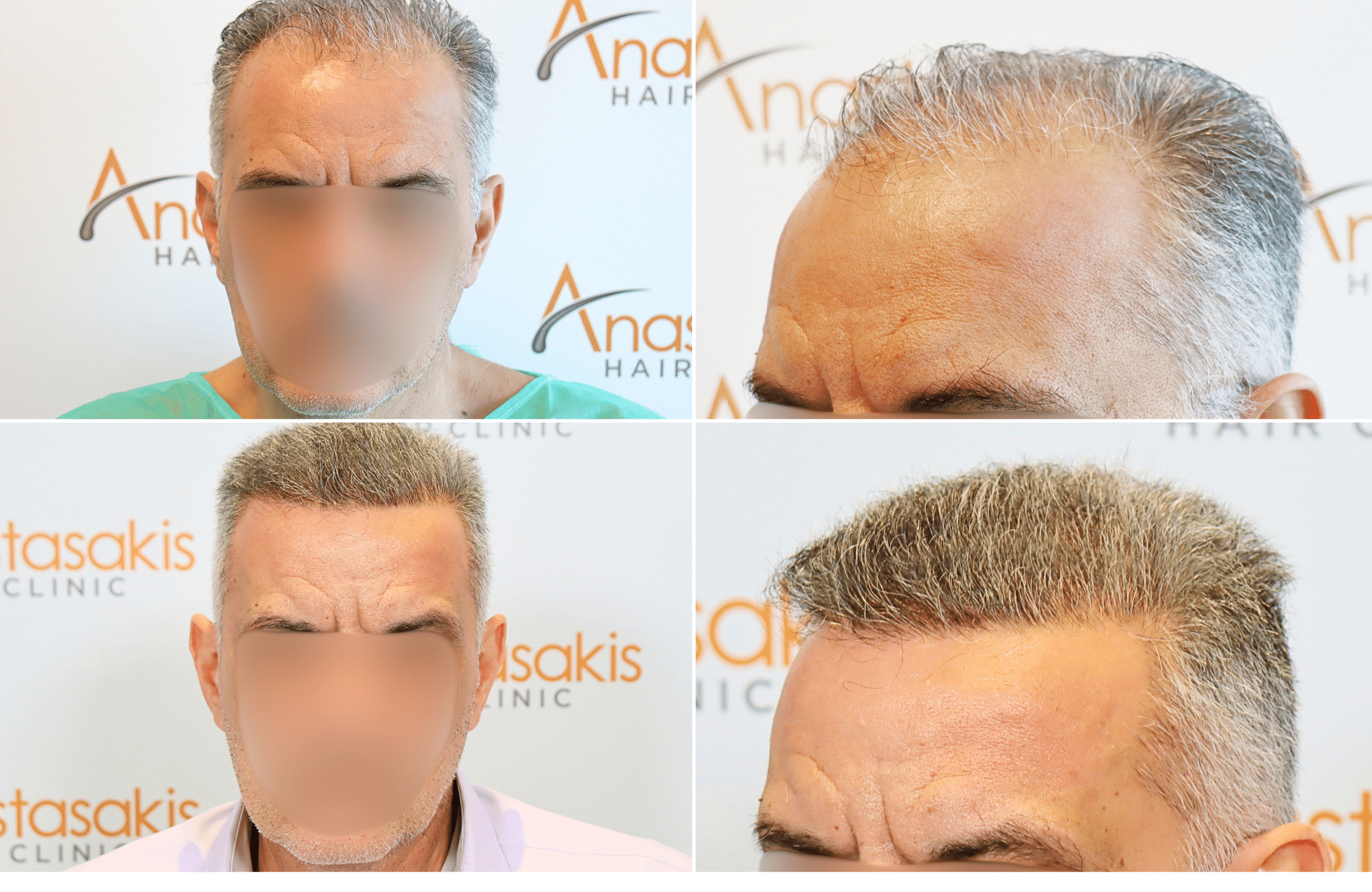 https://www.anastasakishairclinic.gr/portfolio/apotelesma-metamosxefsis-mallion-anastasakis-hair-clinic-80/