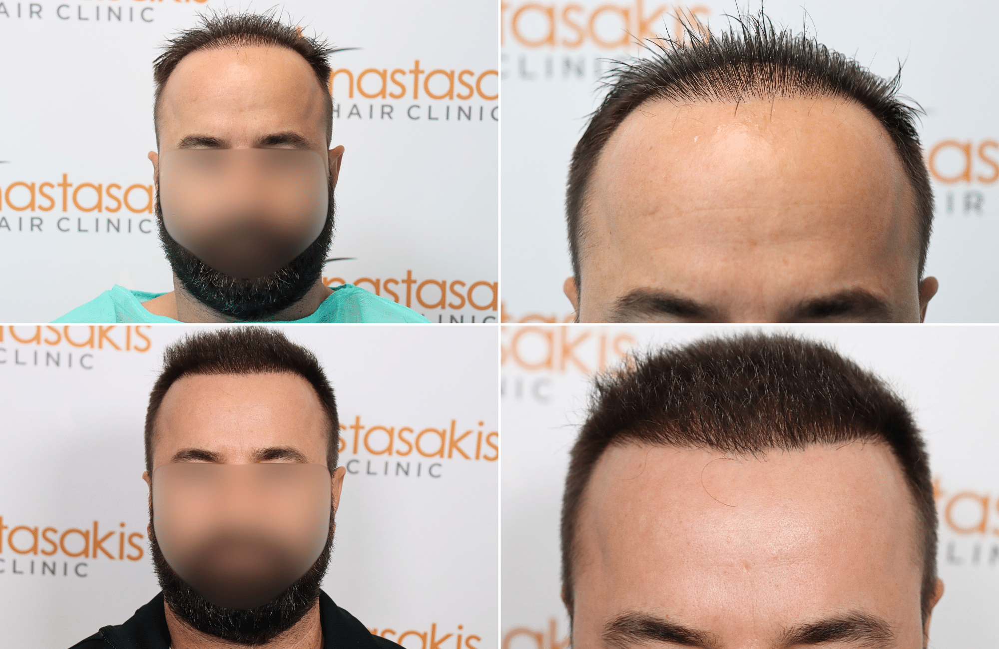 https://www.anastasakishairclinic.gr/portfolio/apotelesma-metamosxefsis-mallion-anastasakis-hair-clinic-165/