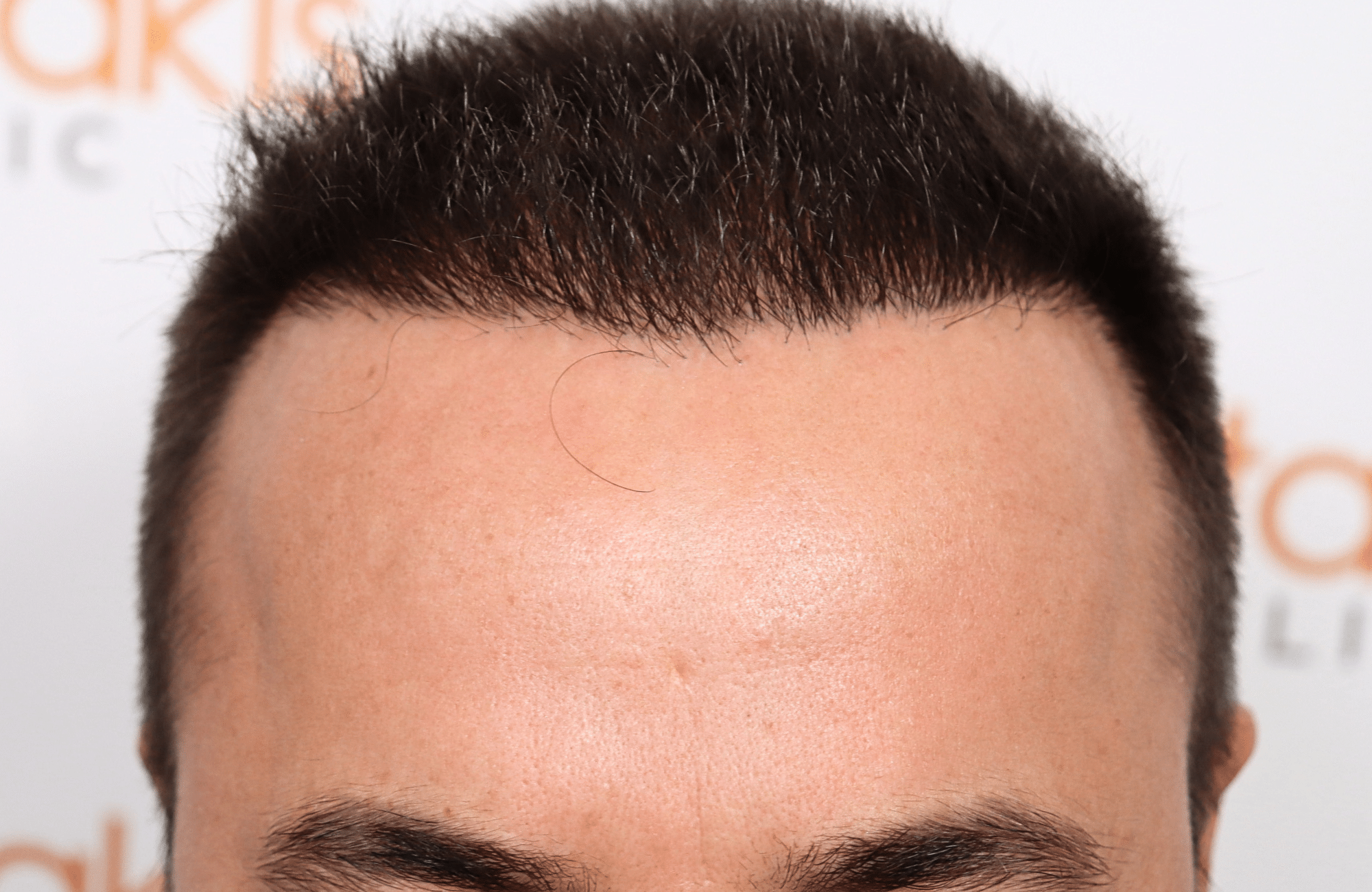 hair transplant result 2600 fus repair