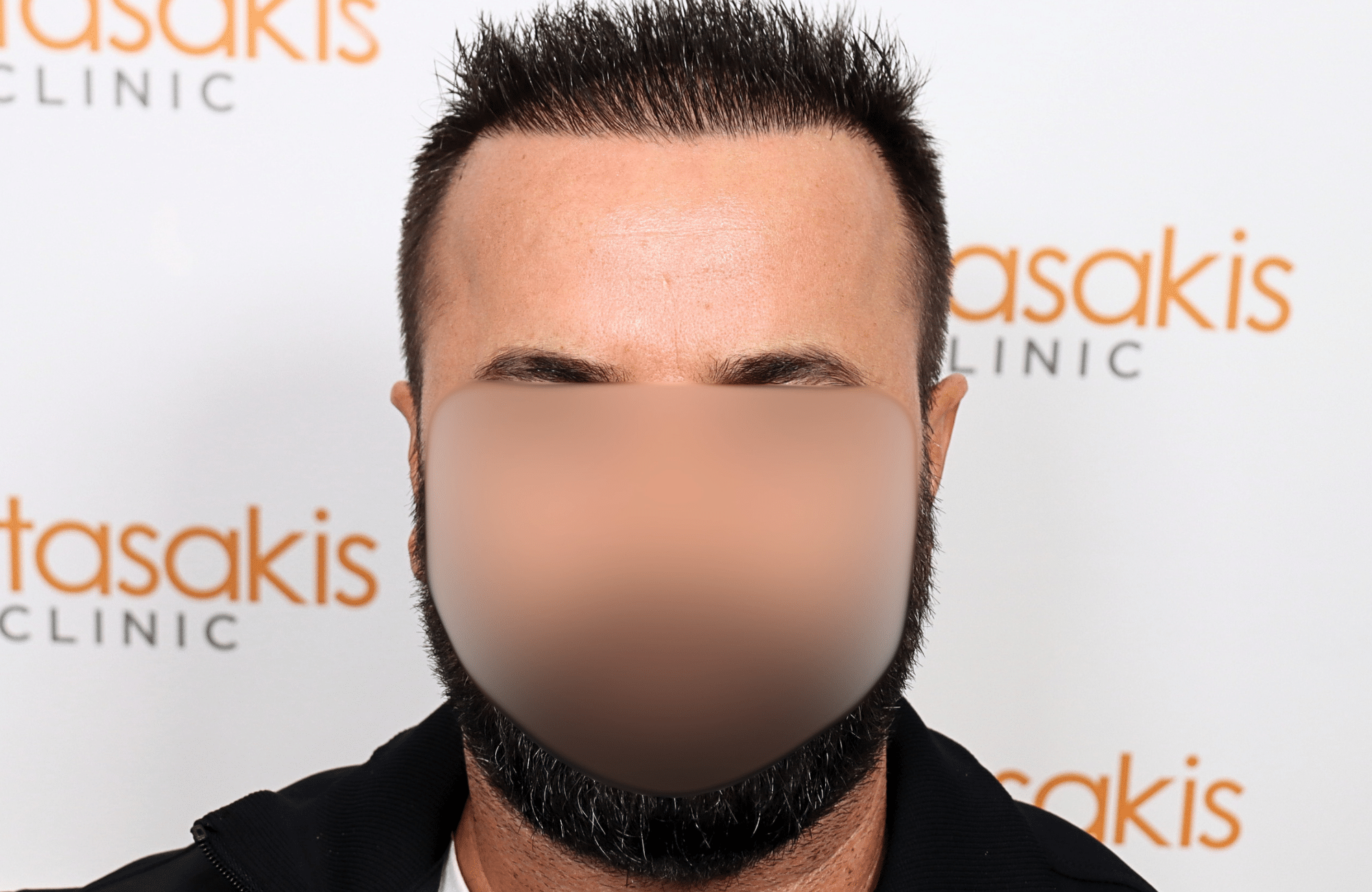 hair transplant result 2600 fus repair