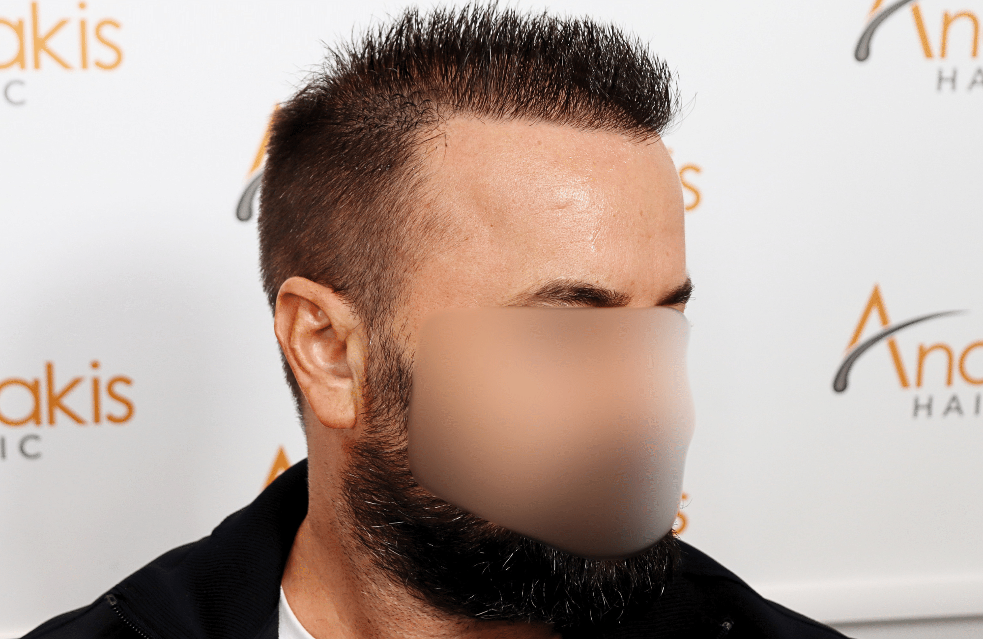 hair transplant result 2600 fus repair