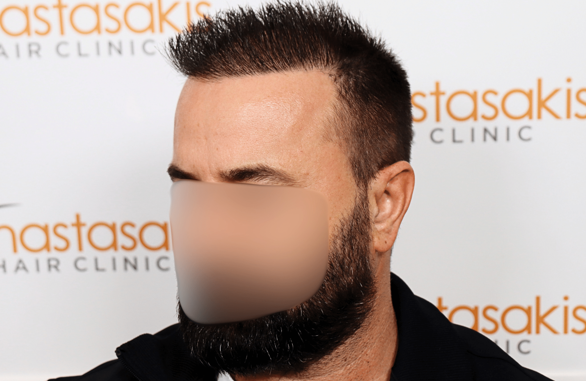 hair transplant result 2600 fus repair