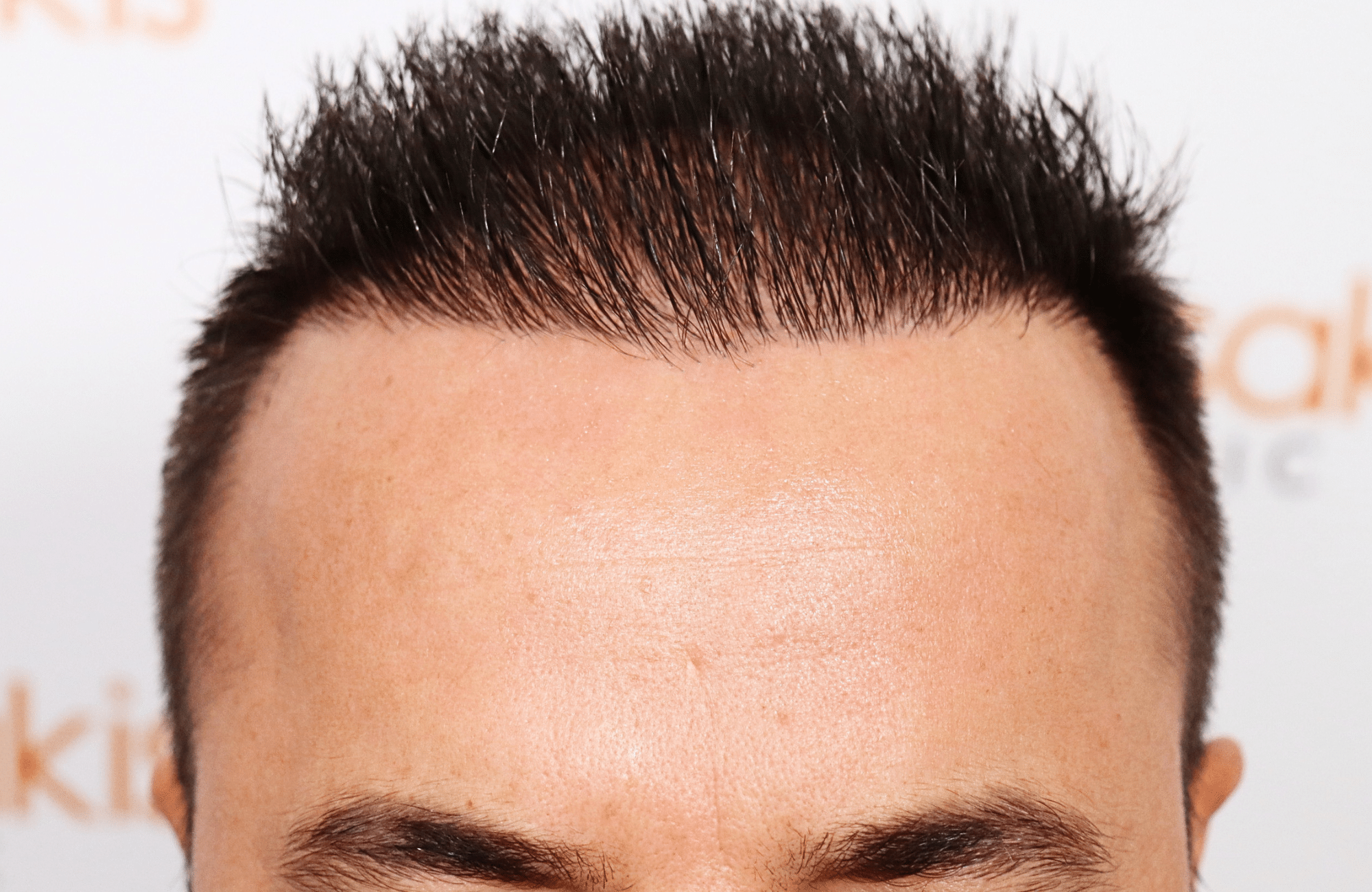 hair transplant result 2600 fus repair