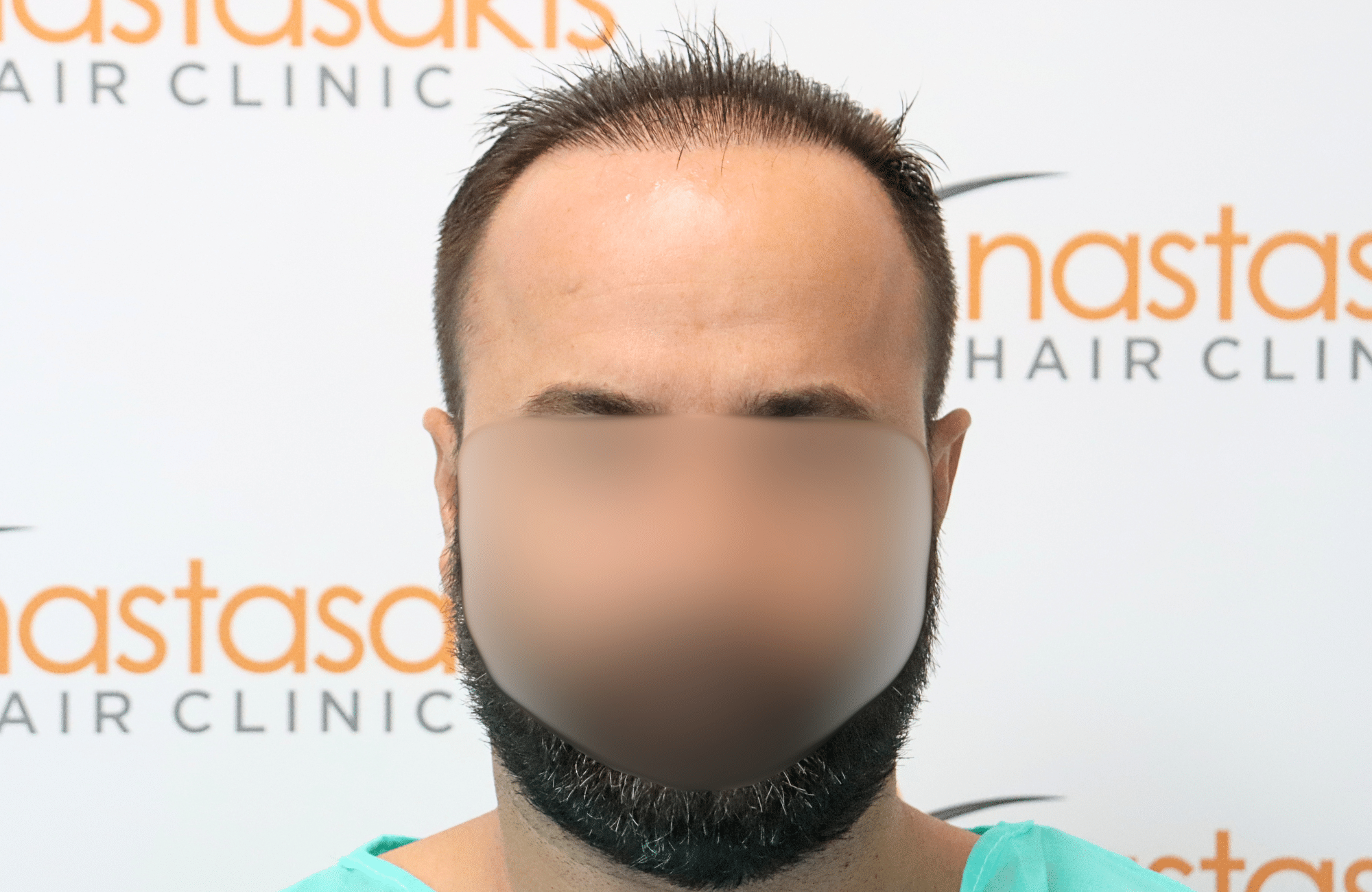 hair transplant result 2600 fus repai