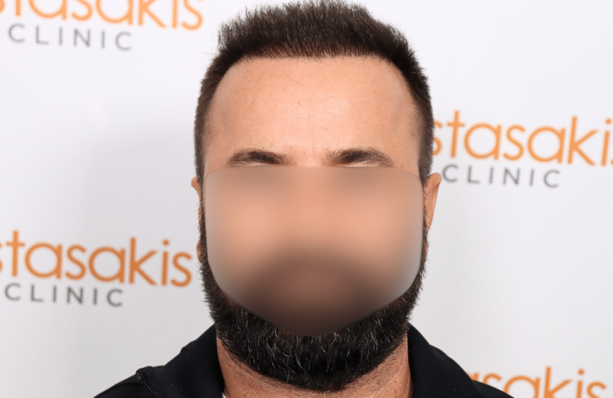 hair transplant result 2600 fus repair