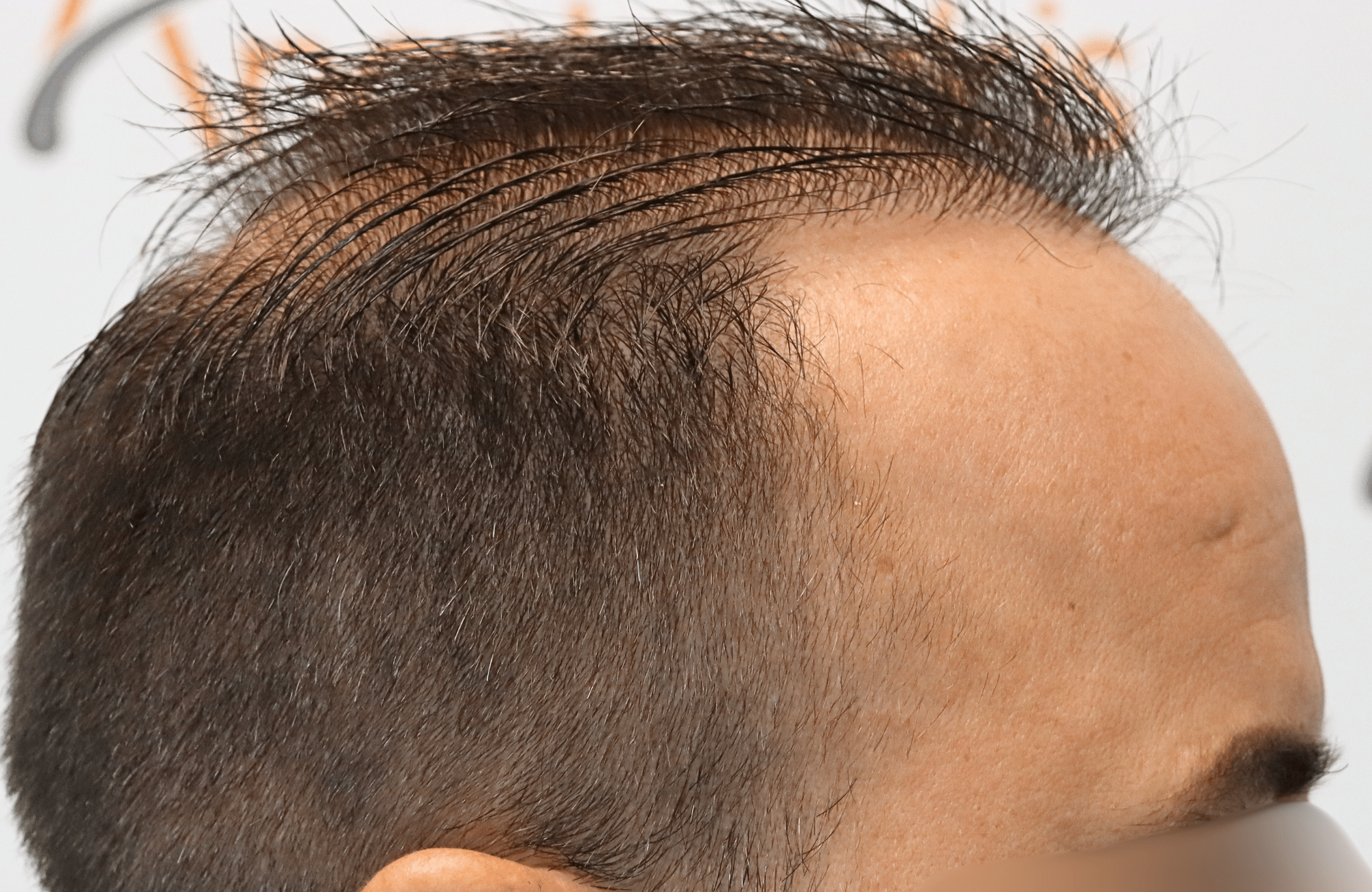 hair transplant result 2600 fus repair