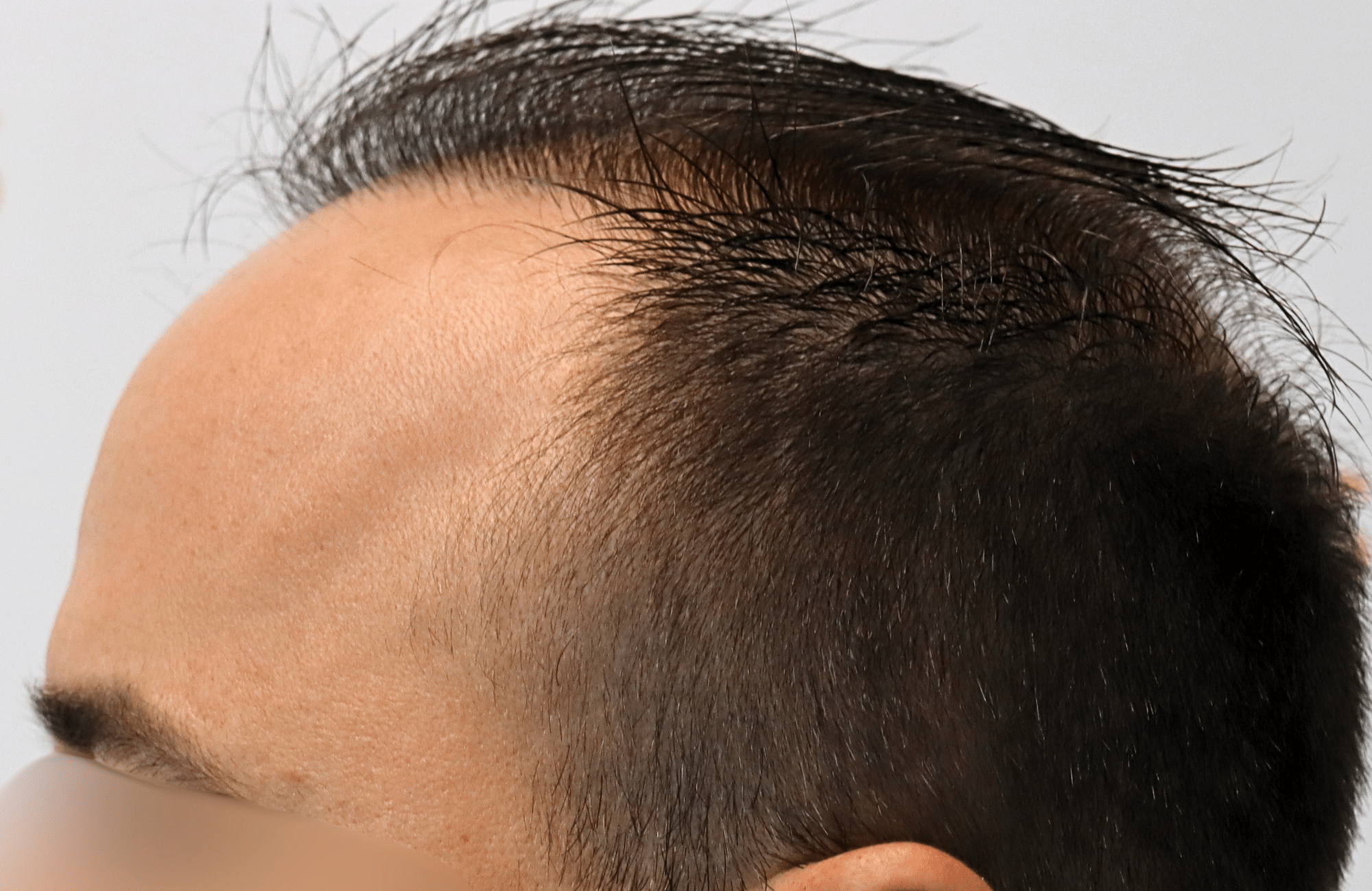 hair transplant result 2600 fus repair