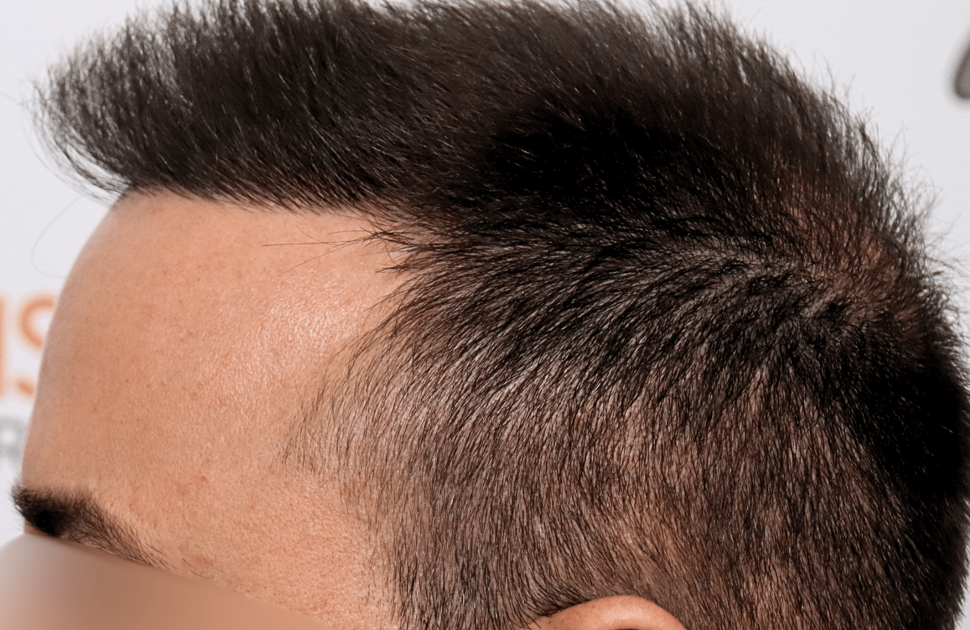 hair transplant result 2600 fus repair