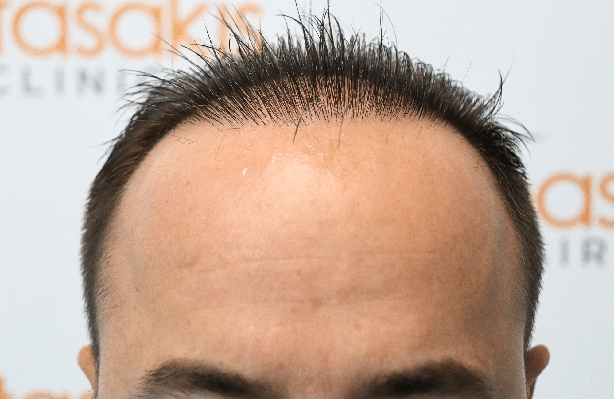 hair transplant result 2600 fus repair