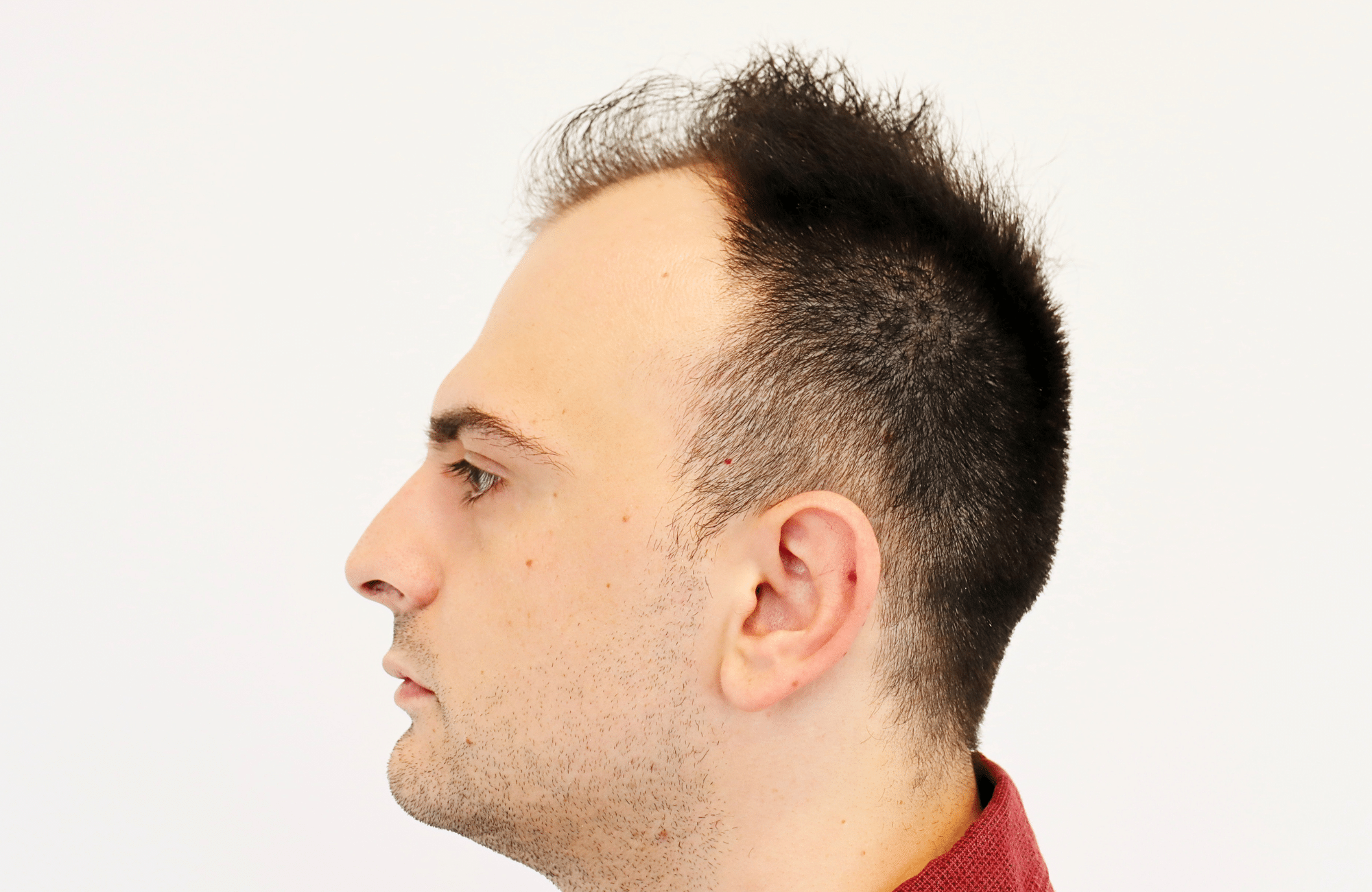 hair transplant result 2600 fus stage 4 thick frontal (11)