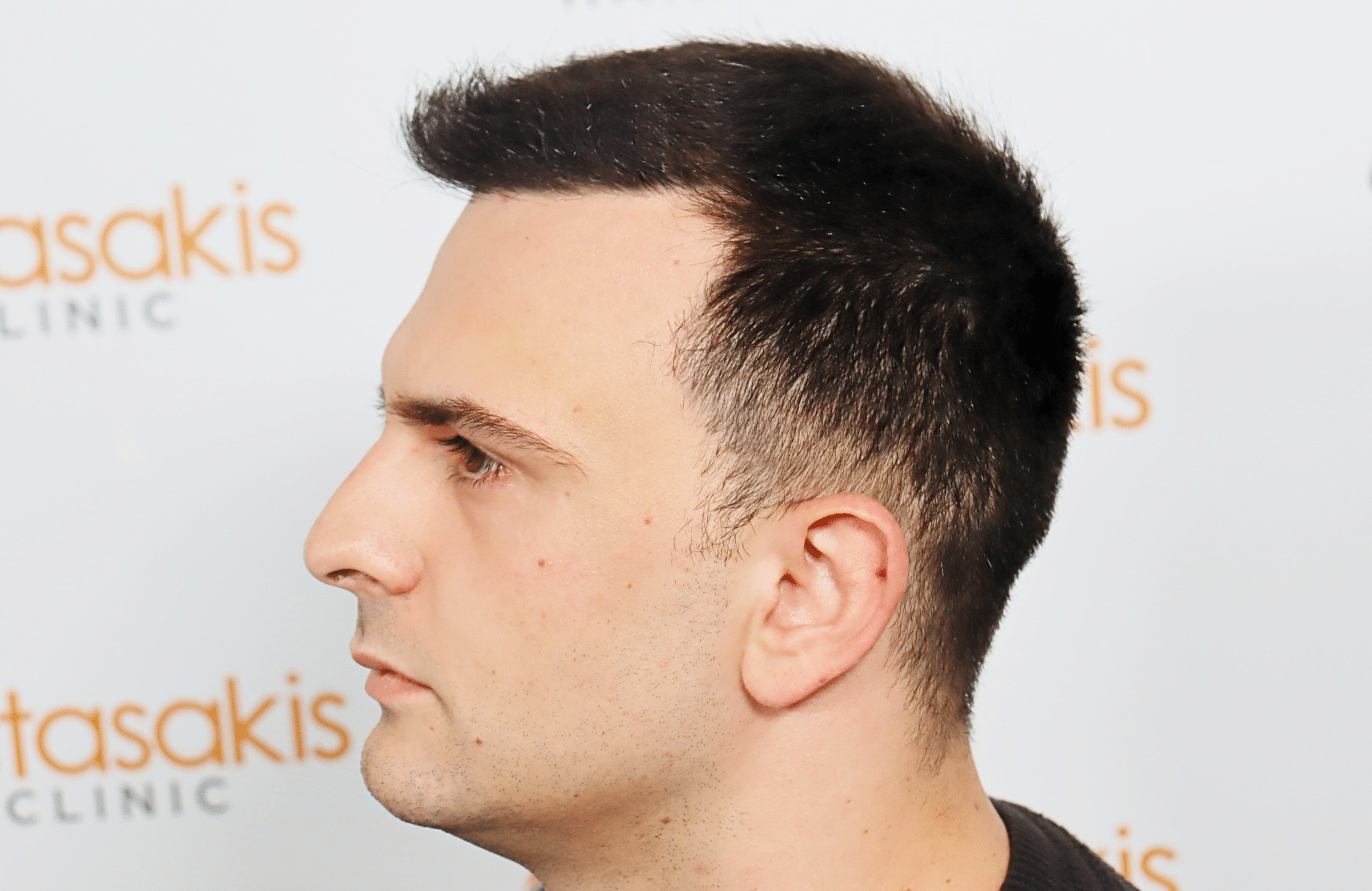 hair transplant result 2600 fus stage 4 thick frontal (12)
