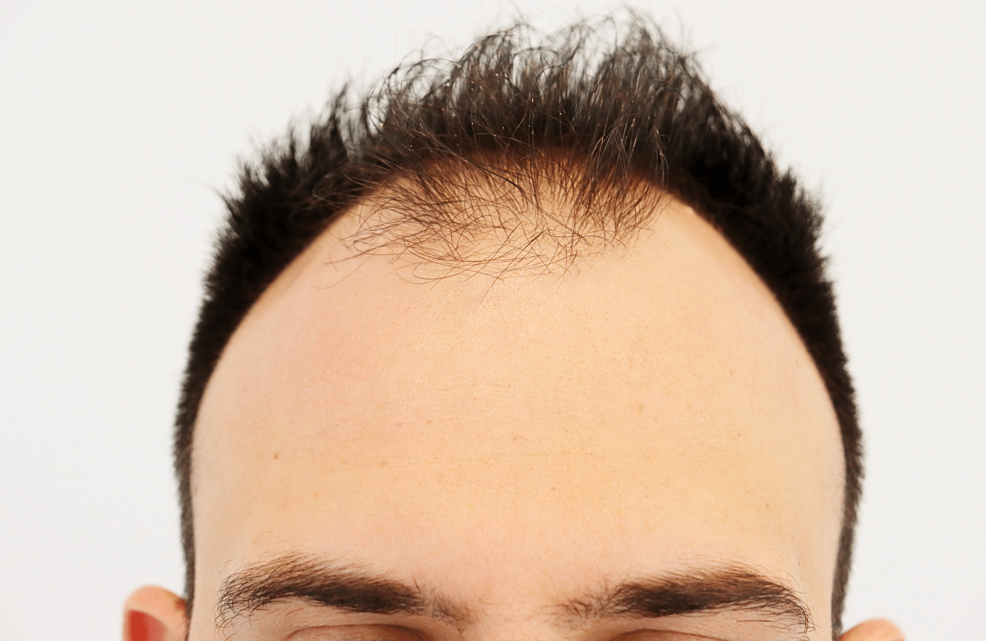 hair transplant result 2600 fus stage 4 thick frontal (13)