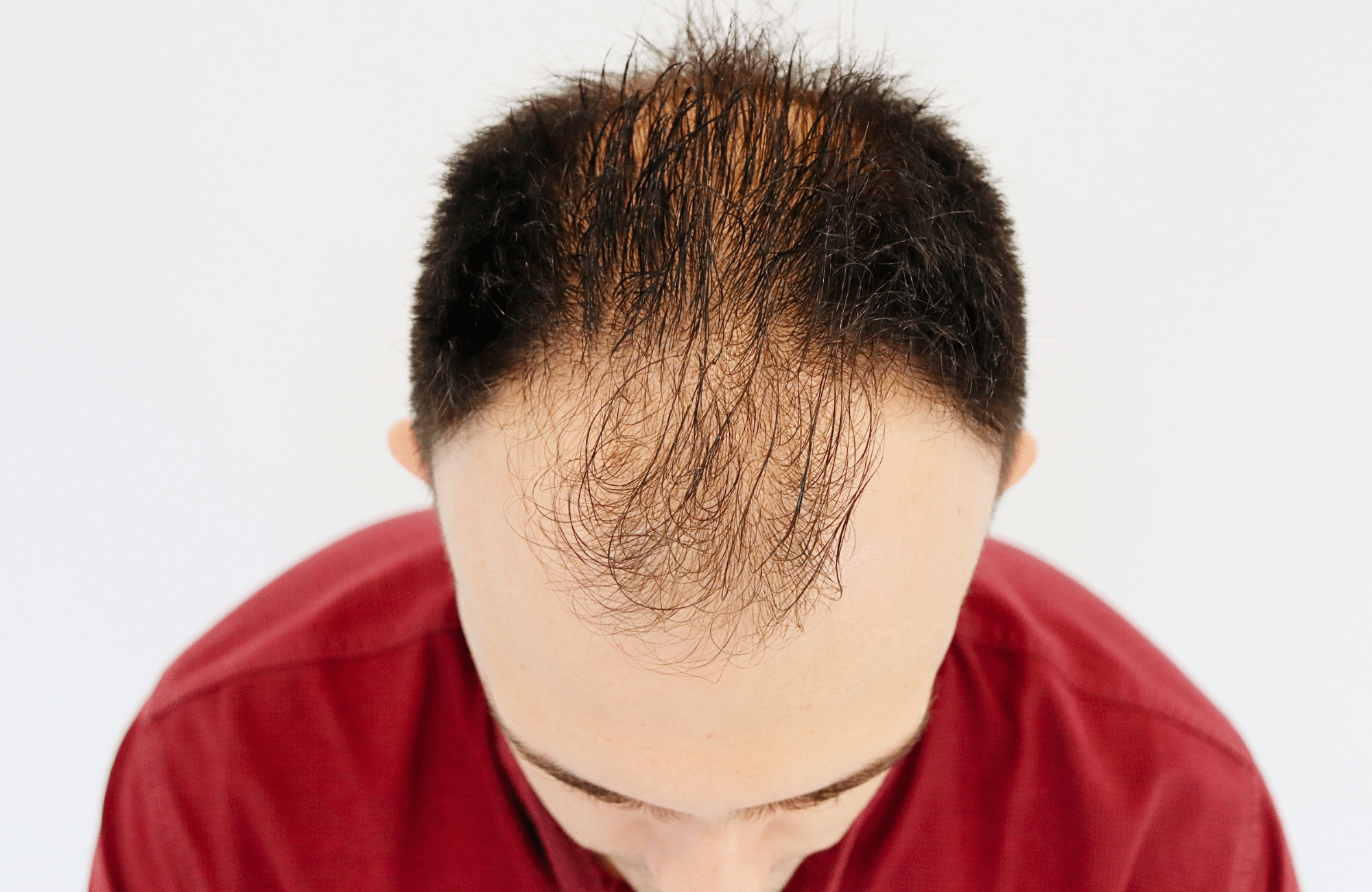 hair transplant result 2600 fus stage 4 thick frontal (16)