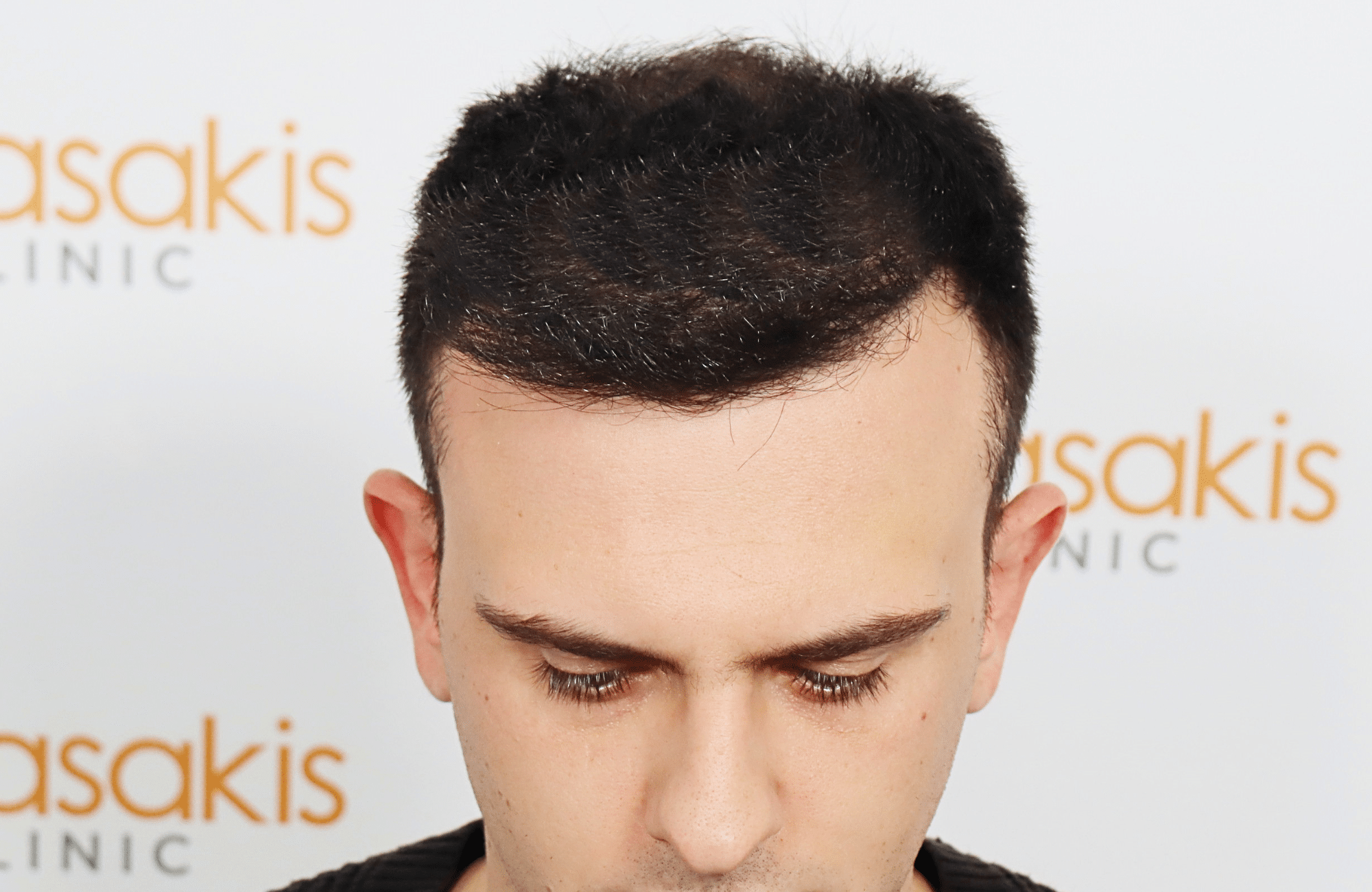 hair transplant result 2600 fus stage 4 thick frontal (17)