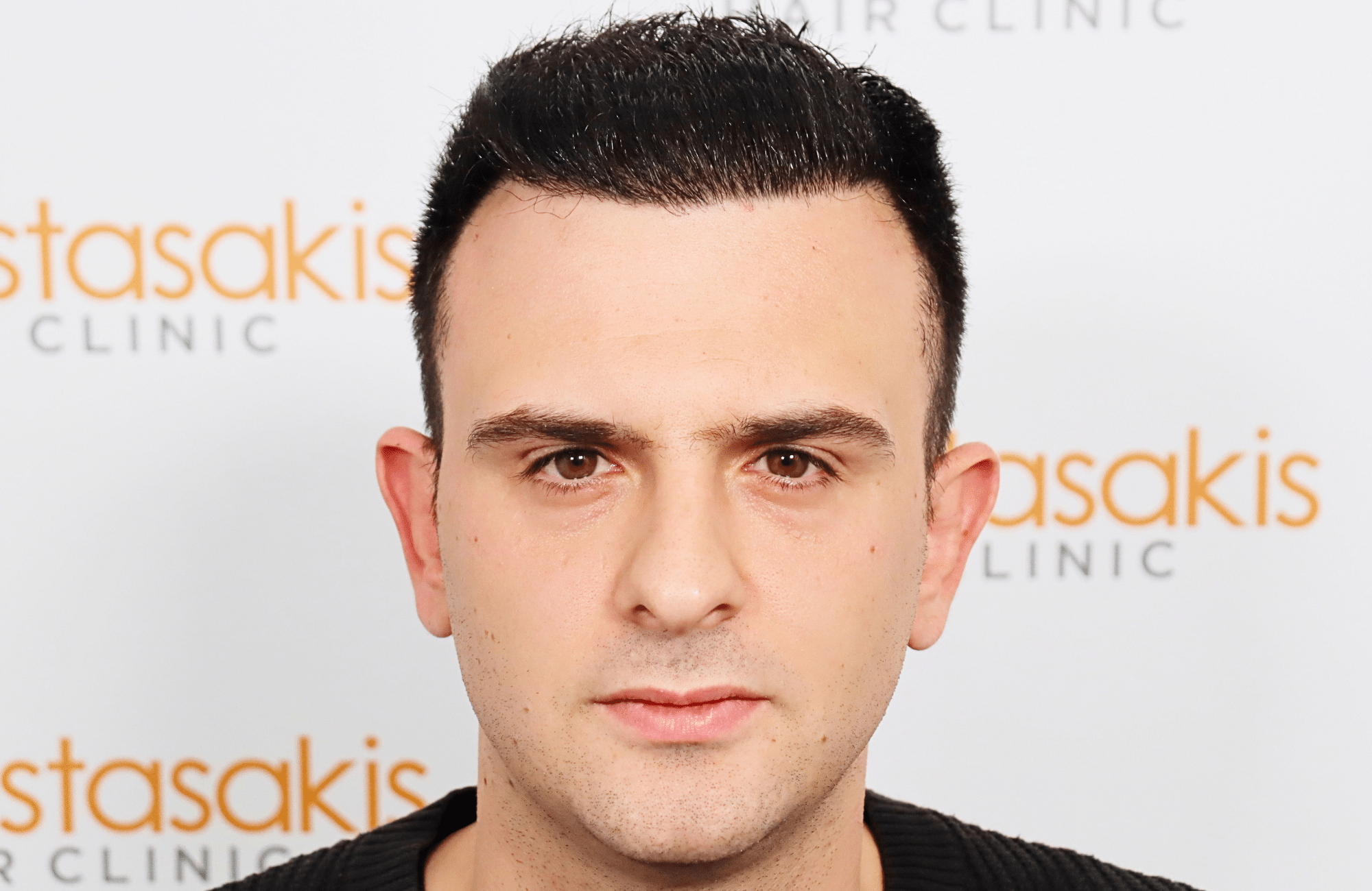 hair transplant result 2600 fus stage 4 thick frontal (18)