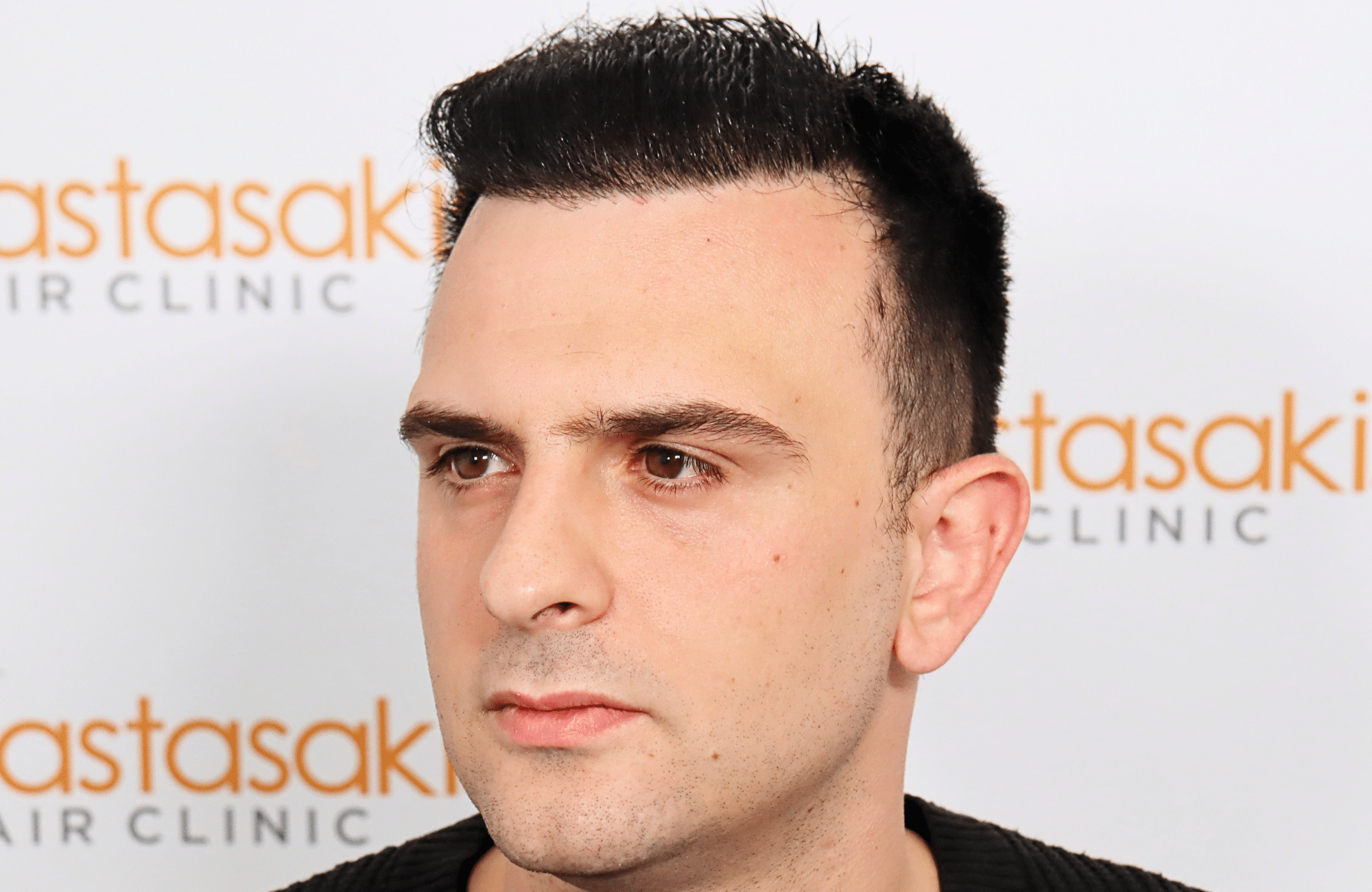 hair transplant result 2600 fus stage 4 thick frontal (19)