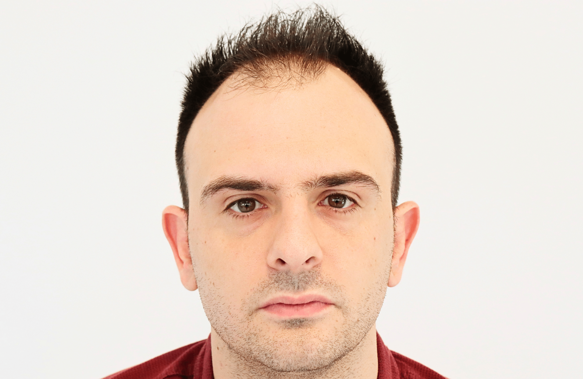hair transplant result 2600 fus stage 4 thick frontal (3)