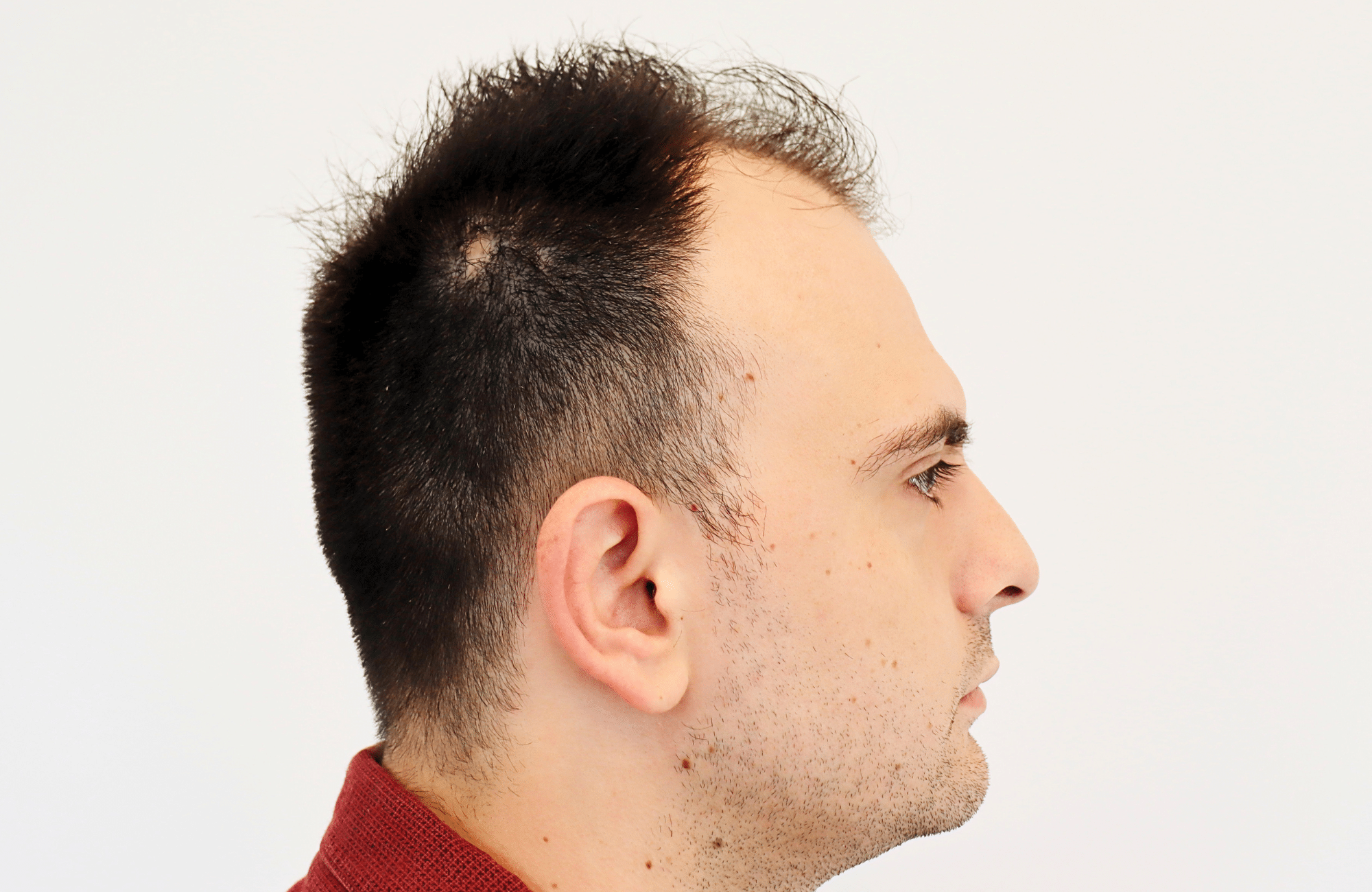 hair transplant result 2600 fus stage 4 thick frontal (9)