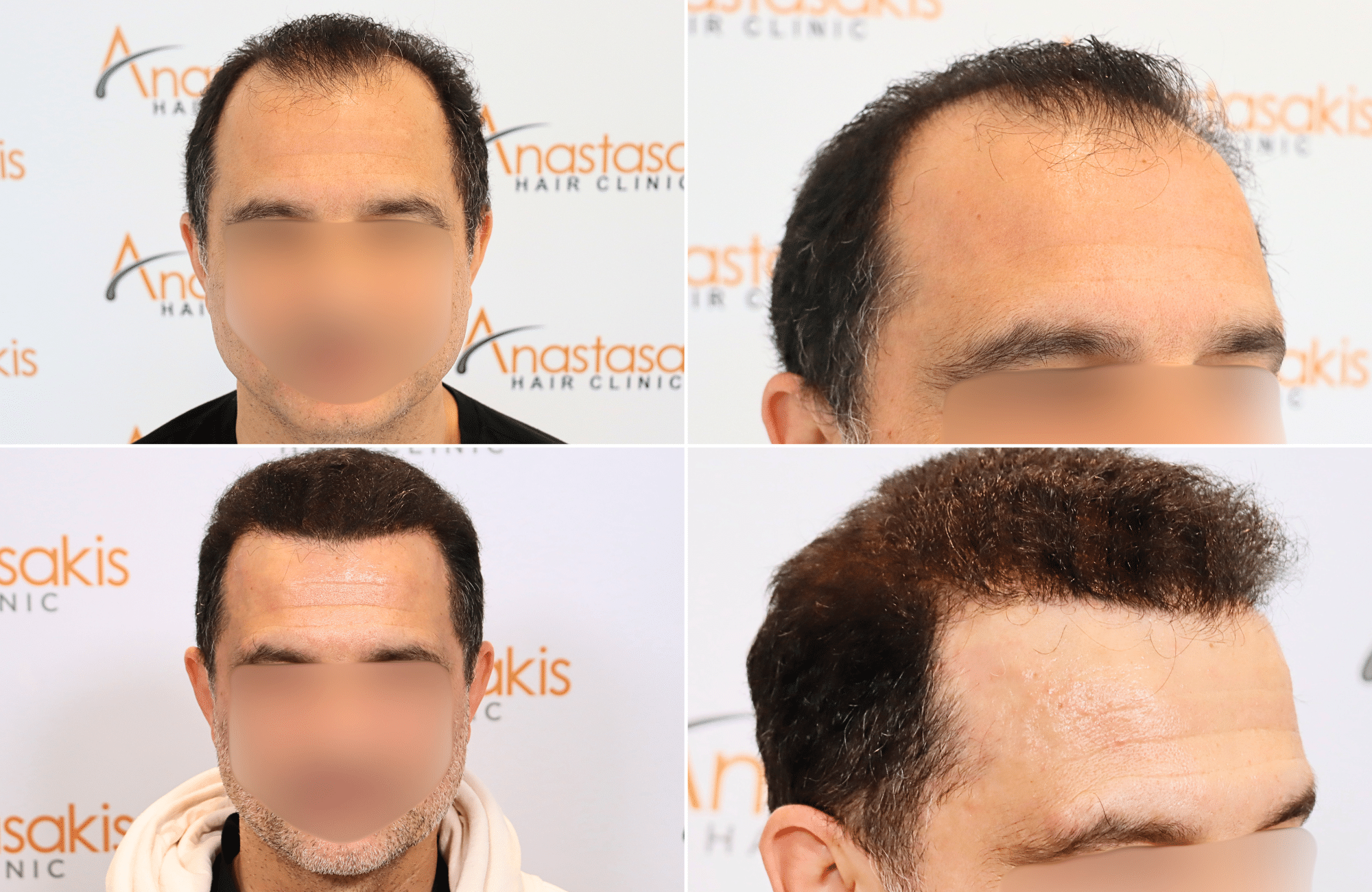 https://www.anastasakishairclinic.gr/portfolio/apotelesma-metamosxefsis-mallion-anastasakis-hair-clinic-124/