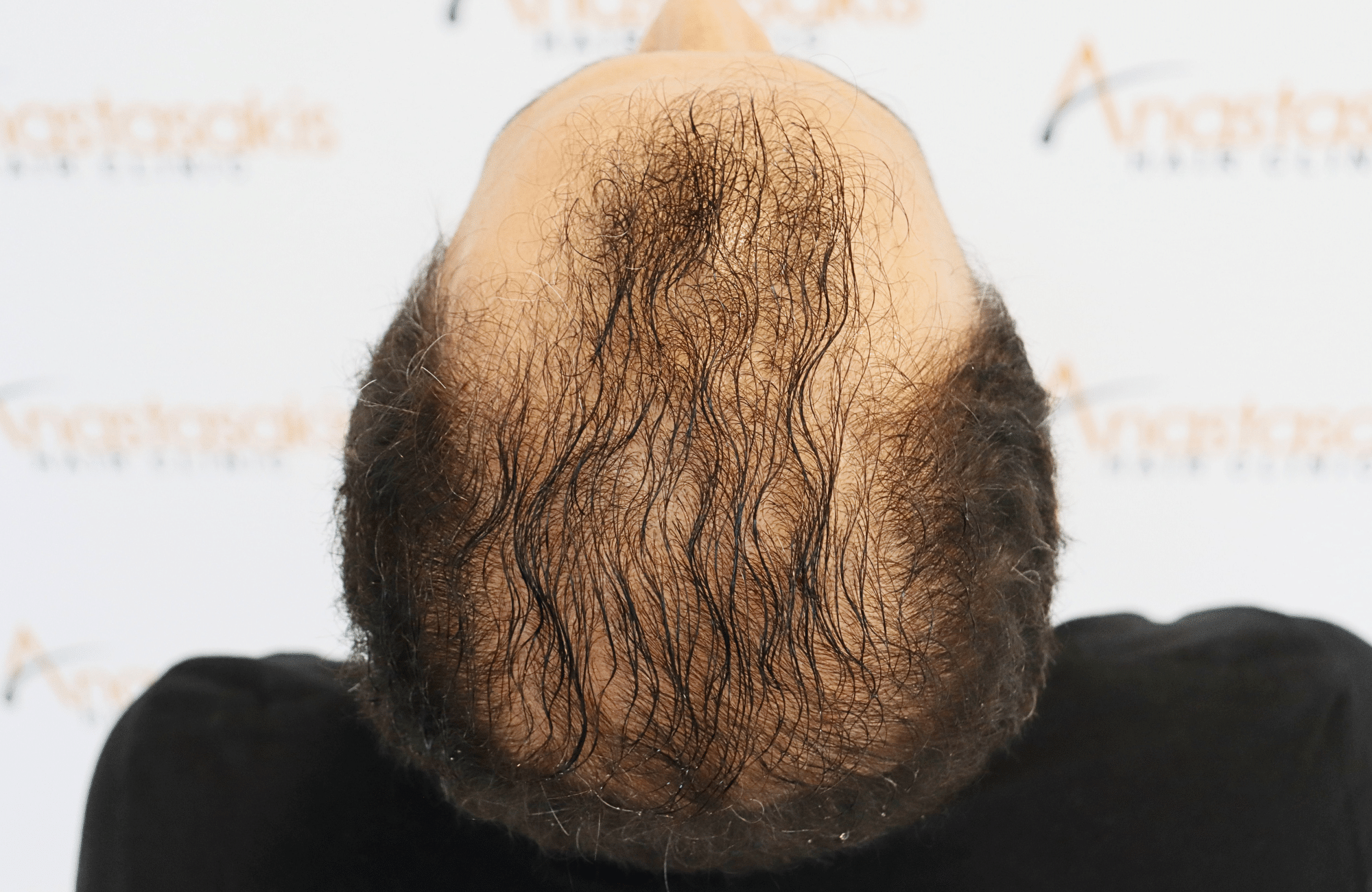 hair transplant result 2600 fus stage 5 diffused (13)
